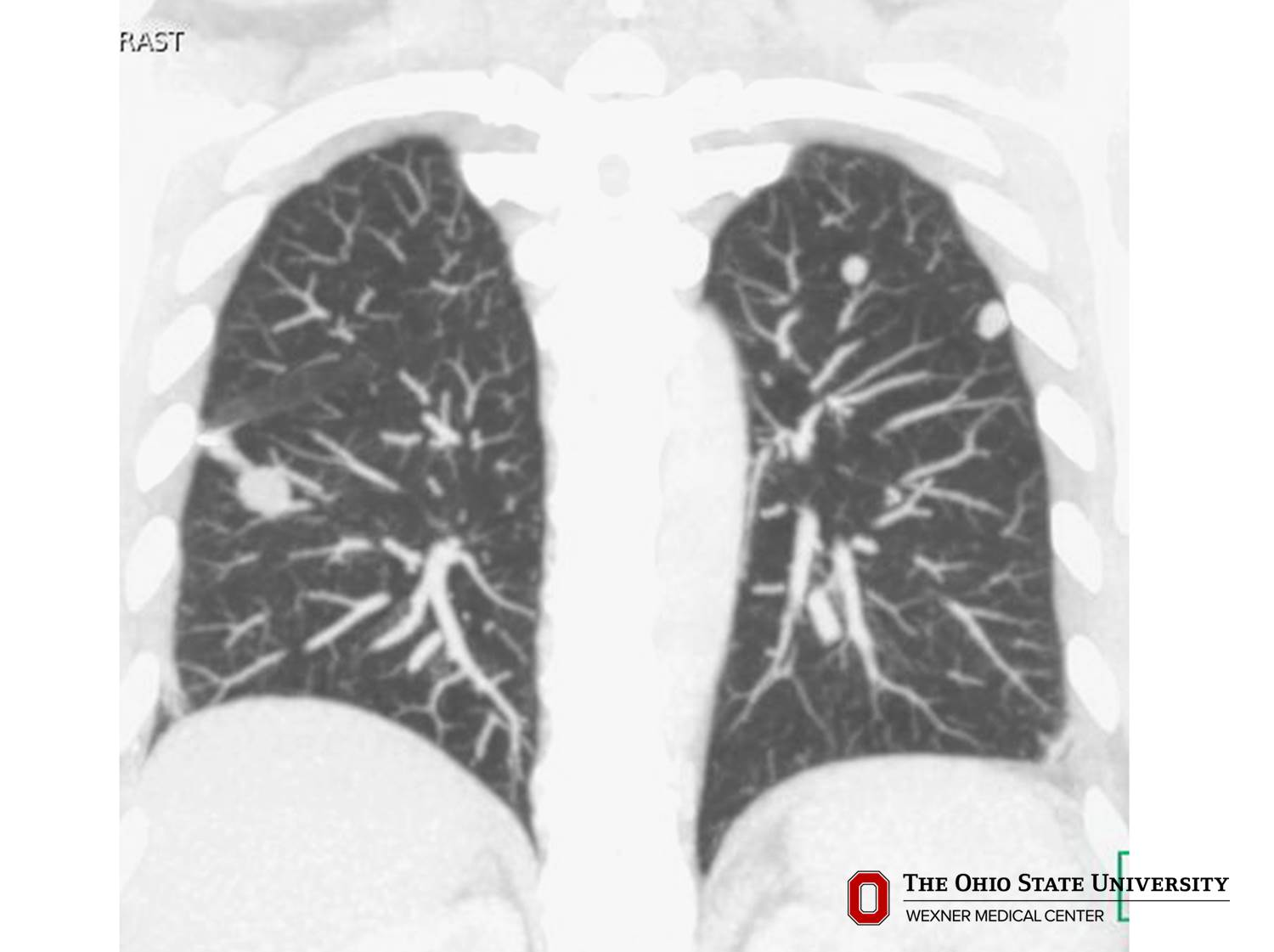 CT scan image possibly detecting cancerous areas in human tissue