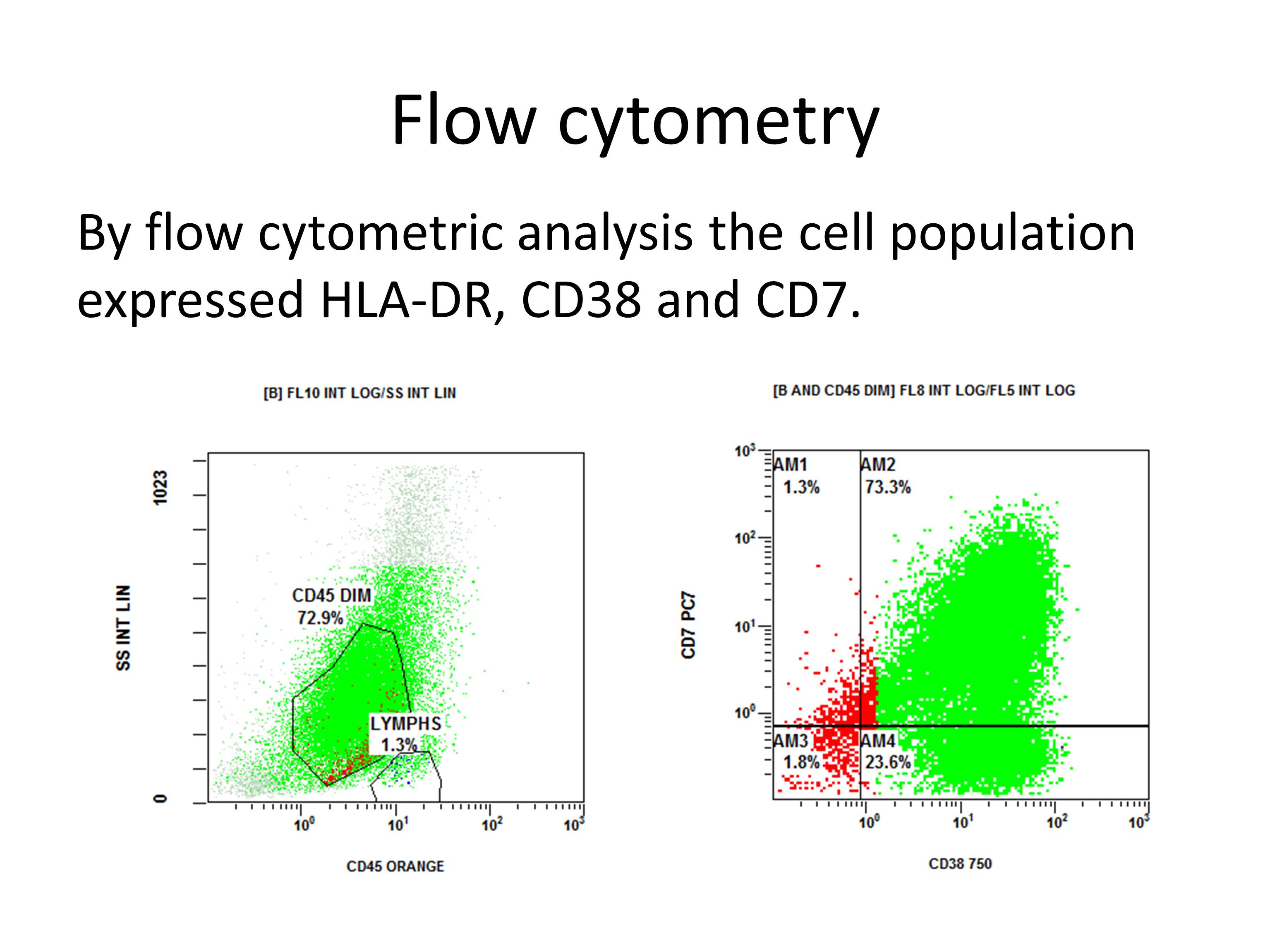 Flo Cytometry analysis />
			             </div>
			        	    <h4>Primary effusion lymphoma (formerly body cavity lymphoma) is one of the least common of acquired immune deficiency syndrome (AIDS) related lymphomas. It accounts for about 4% of all HIV associated non-Hodgkin's lymphomas.(1) The vast majority occur in HIV infected patients, however, this can occur in the absence of infection.(2) The malignant cells of primary effusion lymphoma (PEL) are monoclonal B cells that express cell surface CD38 and contain genomic material from human herpesvirus-8 (100%) and, in many cases, Epstein-Barr virus (80%). It originates on serosal surfaces, including pleura, pericardium and peritoneum.(3) Clinically manifestations depend upon extent and distribution of disease. Symptomatic patients present with dyspnea from pleural/pericardial effusions, abdominal distention, or joint swelling, all related to fluid accumulation. Imaging studies normally reveal evidence of local effusions consistent with accumulation fluid but no detectable mass lesion. However, it may rarely present as an HHV-8 positive solid tumor which predominantly occur in the gastrointestinal tract. Immunohistochemistry is positive for HHV8 (essential for diagnosis), plasma cell associated markers (CD138, VS38c, CD38 , EMA, IRF-4/MUM 1), CD30, CD45; variable for cytoplasmic Ig λ light chain and negative for pan B cel markers (CD19, CD20, CD79 and Pax-5). While present in this case, CD7 positivity is not typical of this disease. In situ EBER (+) is seen in 80% of the cases and flow cytometry is positive for CD45/LCA.  
                            </h4>
                           <h4>Primary effusion lymphoma has  also been associated with Castleman disease, a lymphoproliferative disorder  that causes  excessive cytokine release secondary to the expression of the HHV-8 cytokine, vIL-6. This can progress to plasmablastic lymphoma and can also be associated with other plasma cell dyscrasias, Kaposi sarcoma and primary effusion lymphoma (4) as in this case.  
                            </h4>
                            
                        

			             </div>
                    
                        </div>
						
					    
					    
					    
					    
					    <div class=