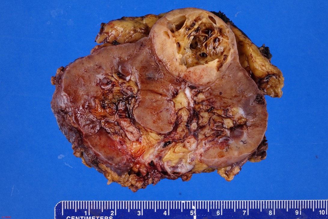 Gross image of liver
