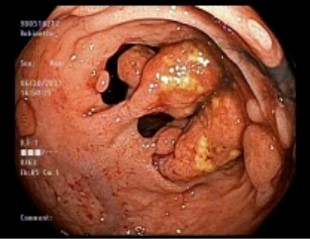 Small bowel endoscope image