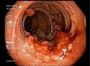 Small bowel endoscope image