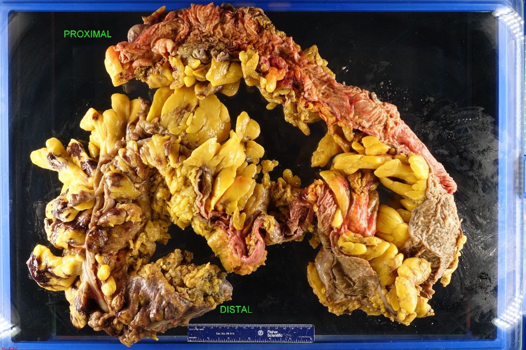 Gross image of small bowel