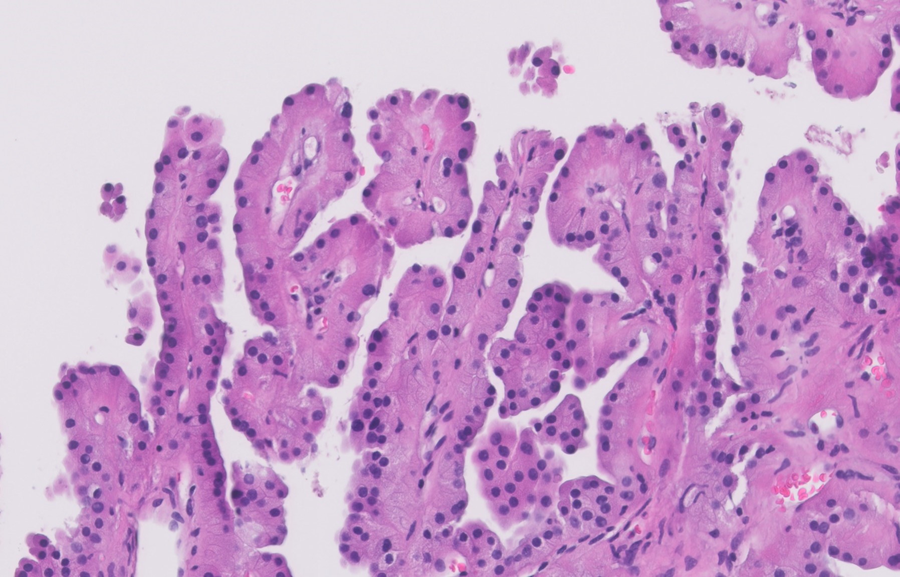 Microscopic image possibly detecting cancerous areas in human tissue