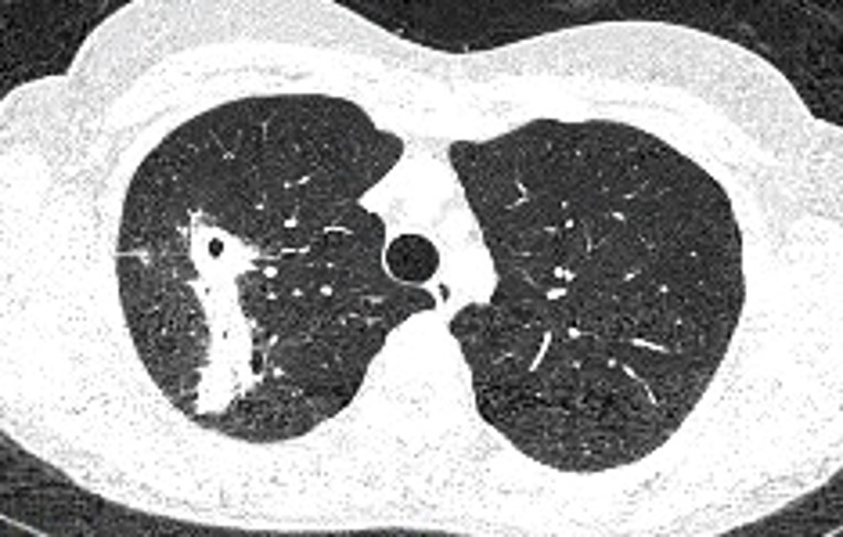 CT scan of lungs