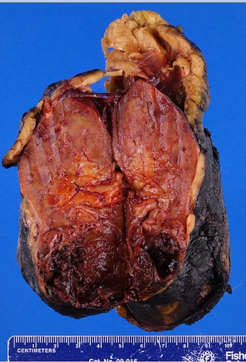 Gross image of kidney