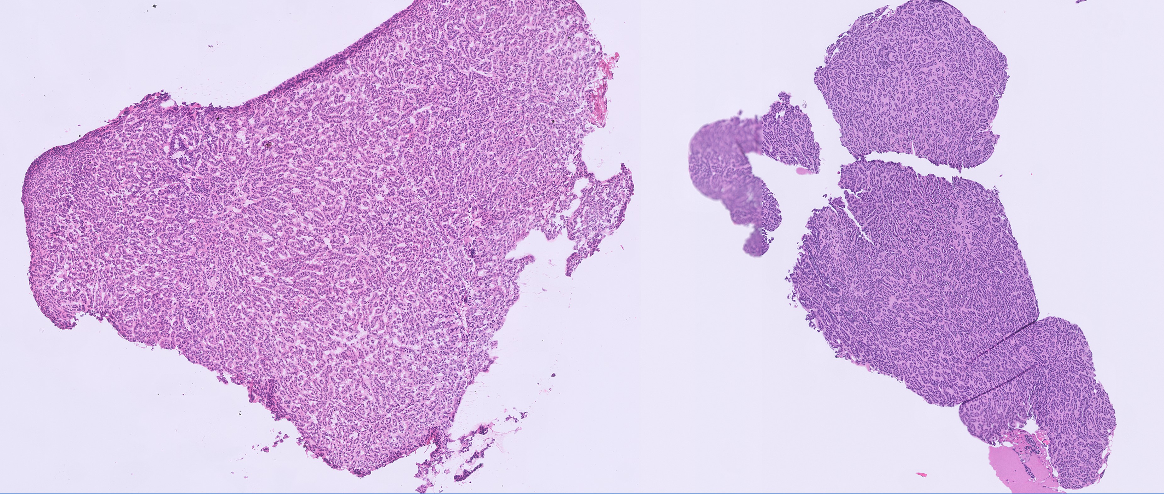 Microscopic image possibly detecting cancerous areas in human tissue