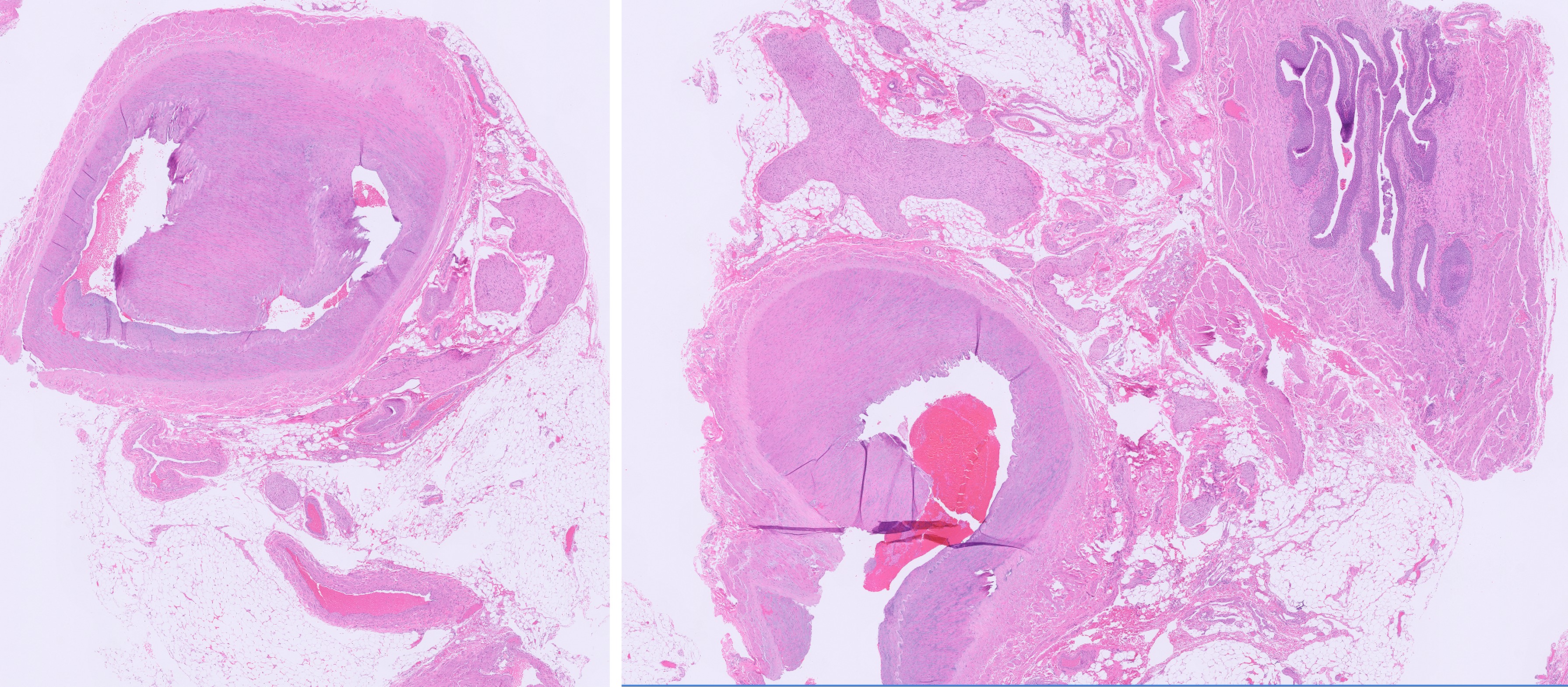 Microscopic image possibly detecting cancerous areas in human tissue