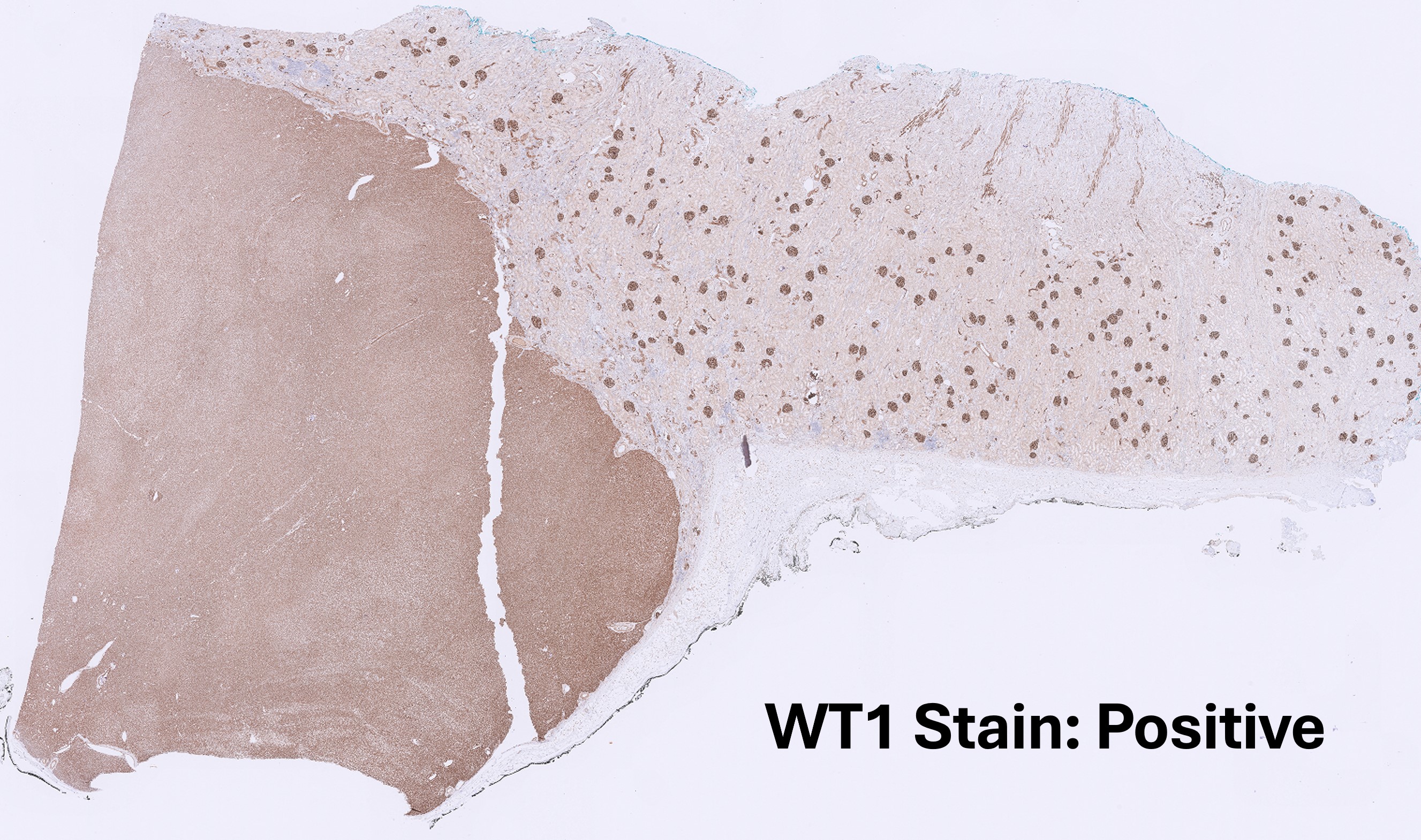 Microscopic image possibly detecting cancerous areas in human tissue