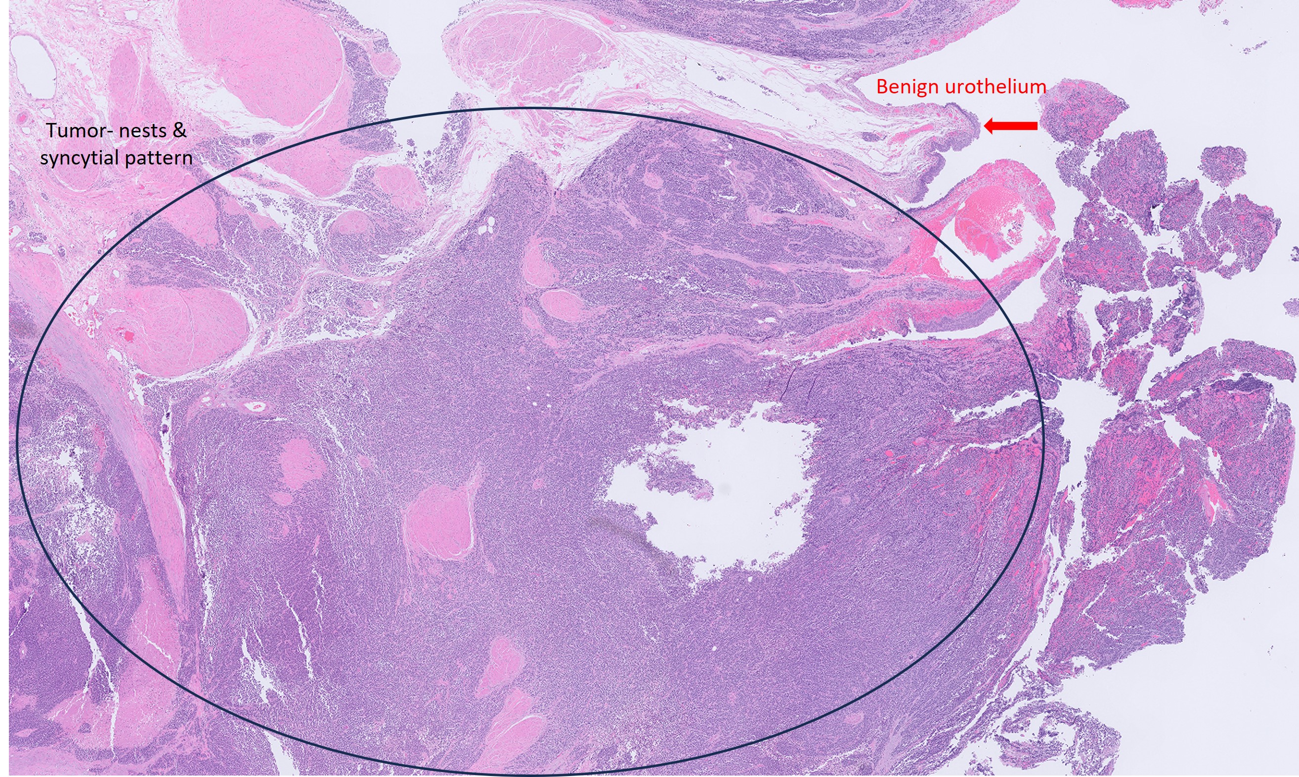 Microscopic image possibly detecting cancerous areas in human tissue