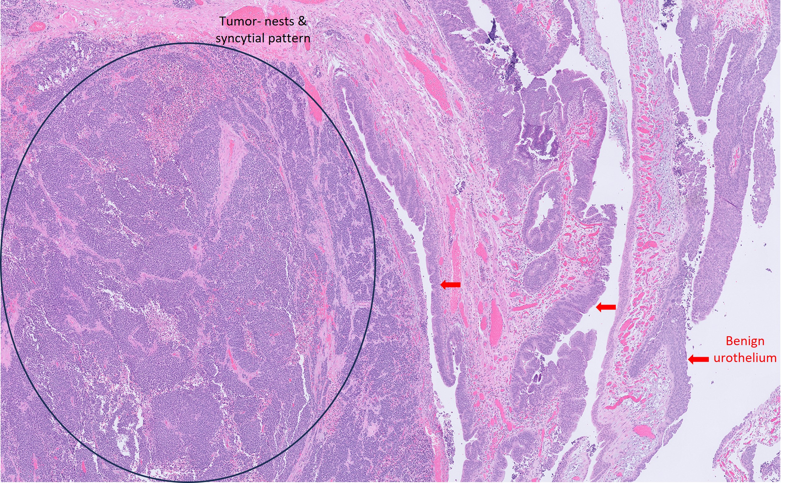 Microscopic image possibly detecting cancerous areas in human tissue