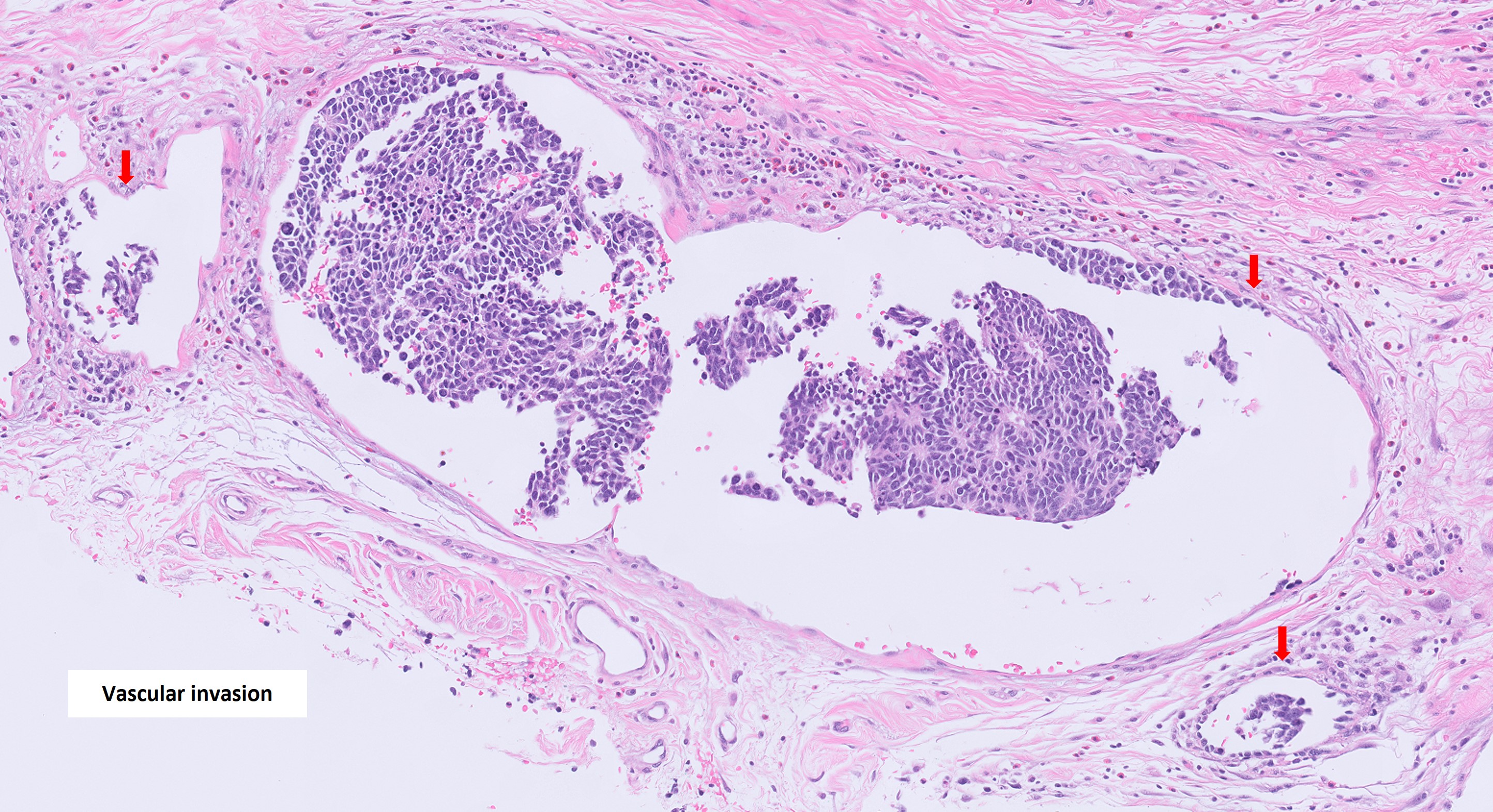 Microscopic image possibly detecting cancerous areas in human tissue