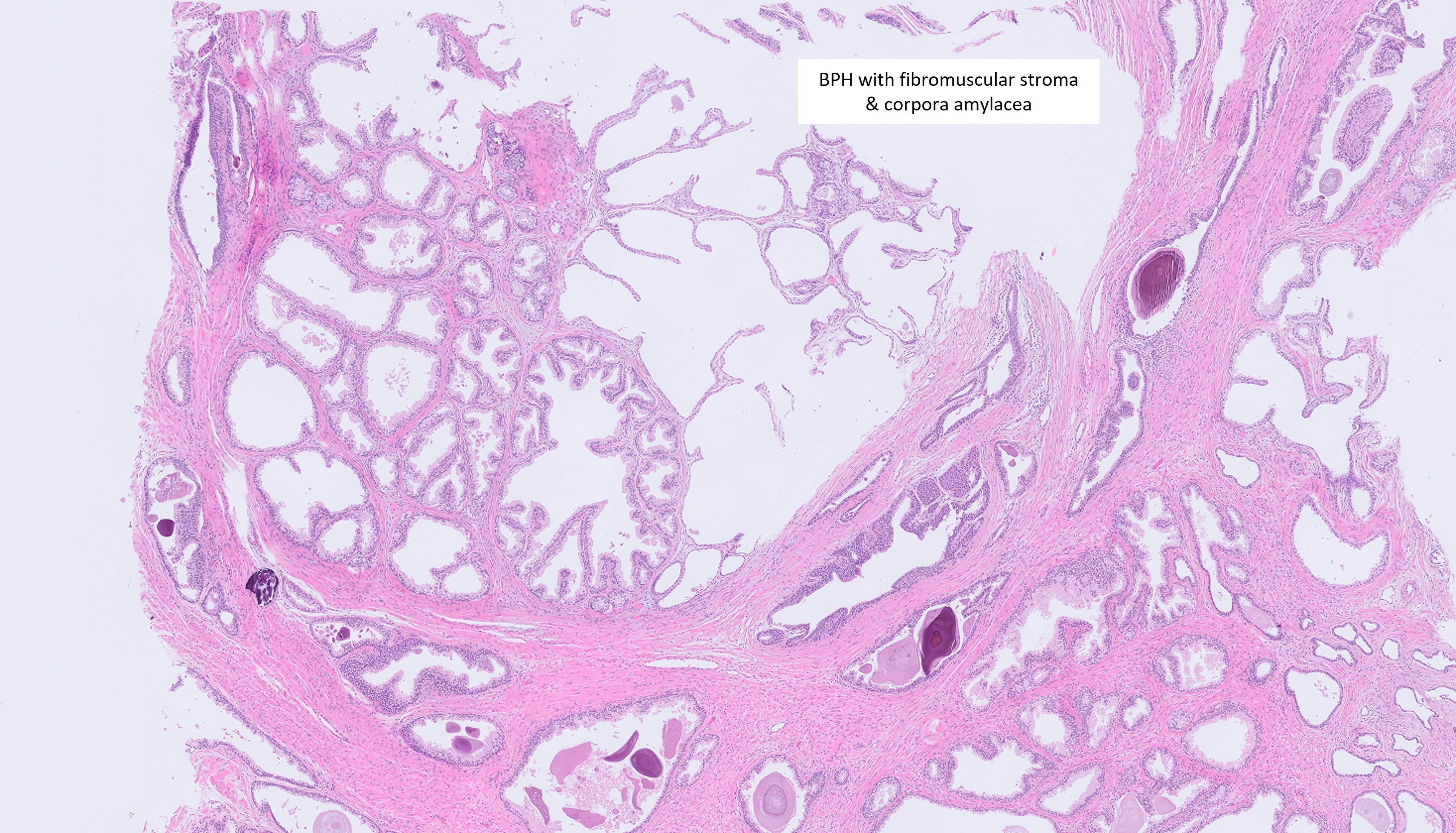 Microscopic image possibly detecting cancerous areas in human tissue