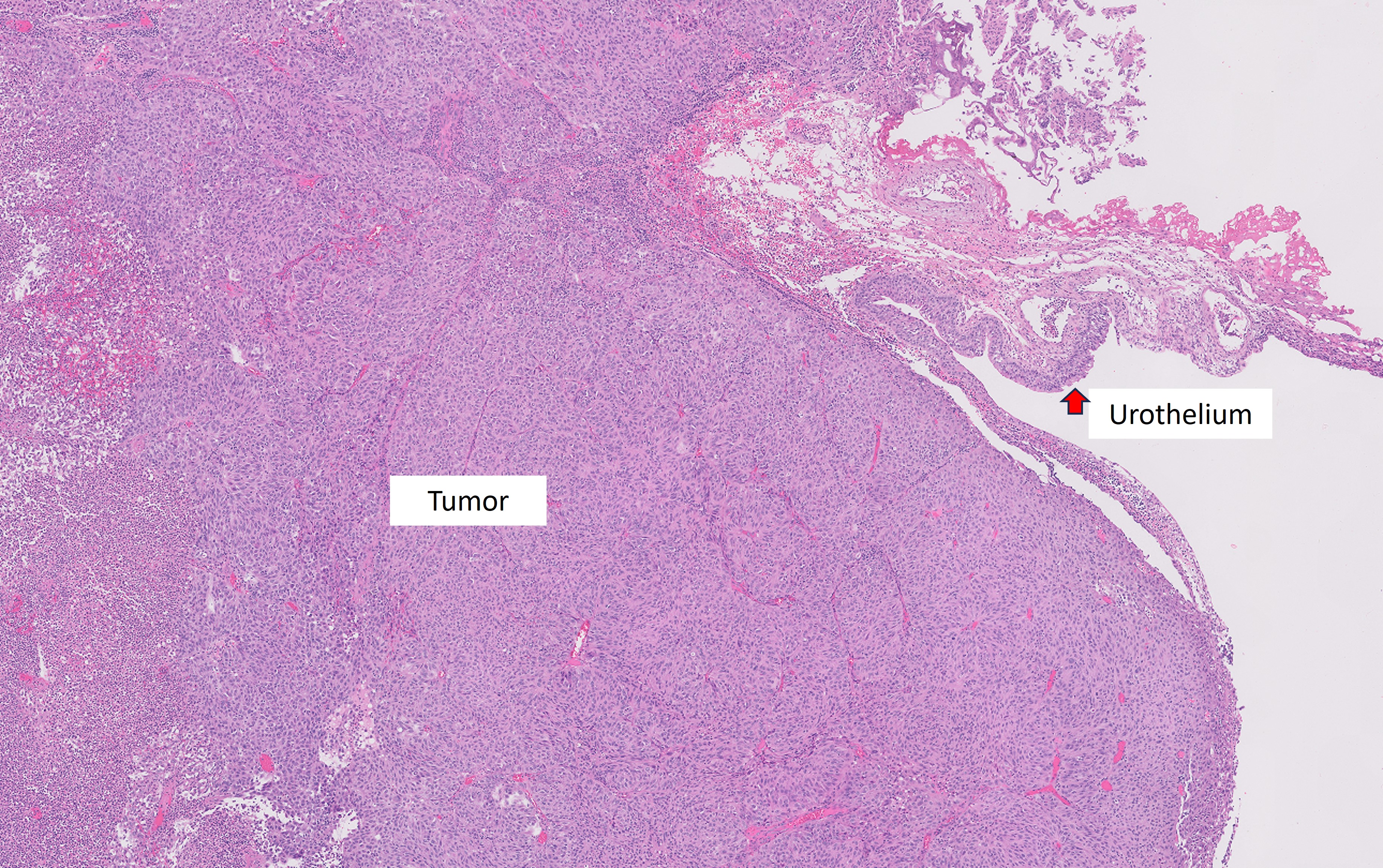 Microscopic image possibly detecting cancerous areas in human tissue