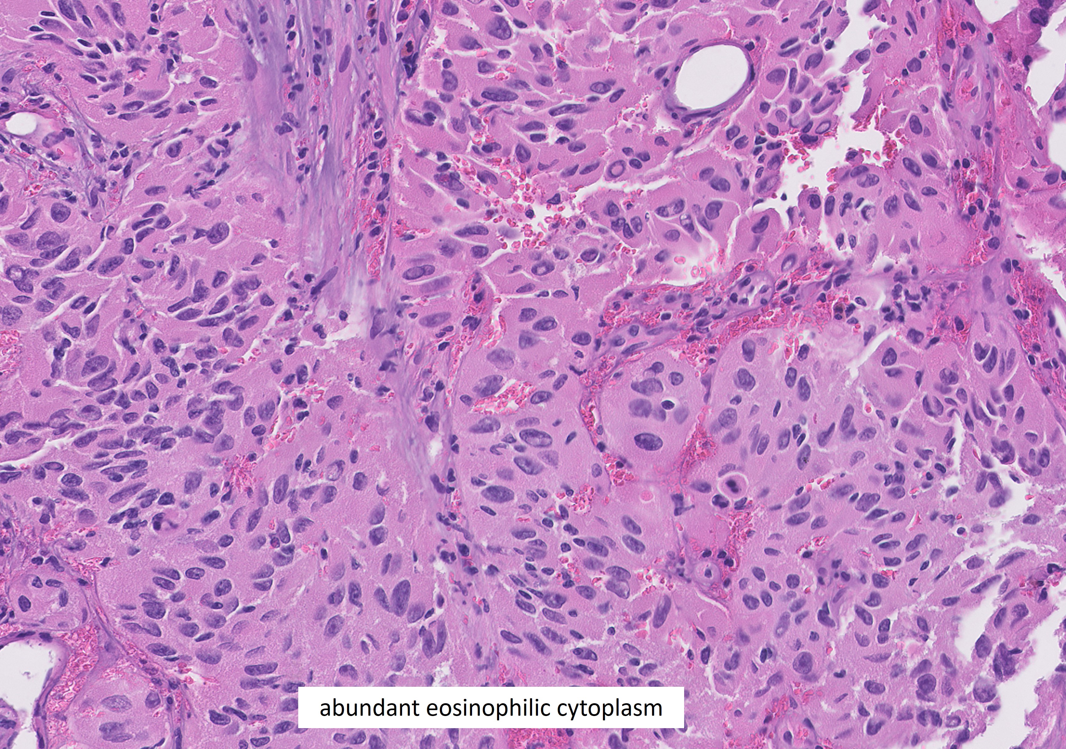 Microscopic image possibly detecting cancerous areas in human tissue