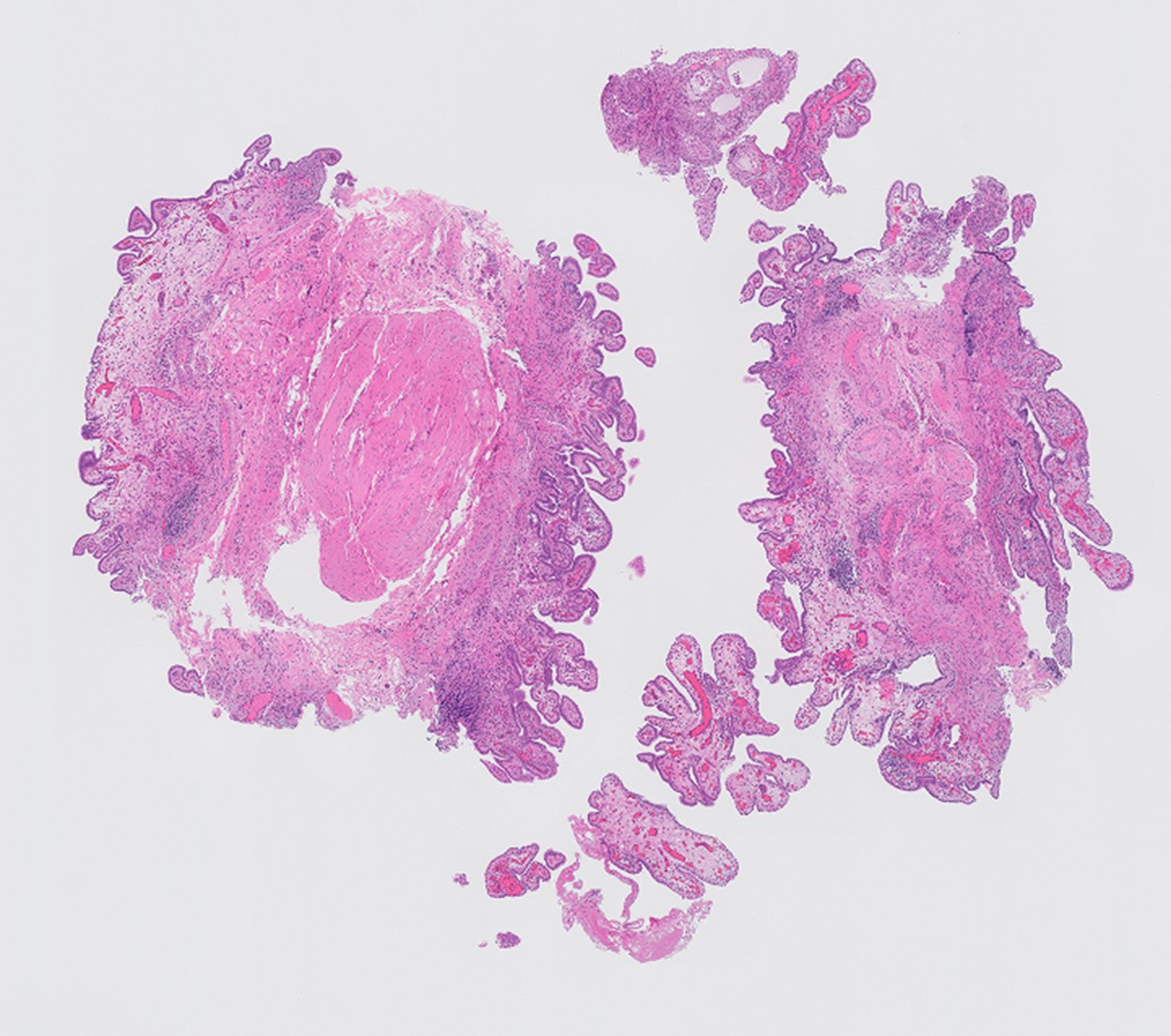 Microscopic image possibly detecting cancerous areas in human tissue