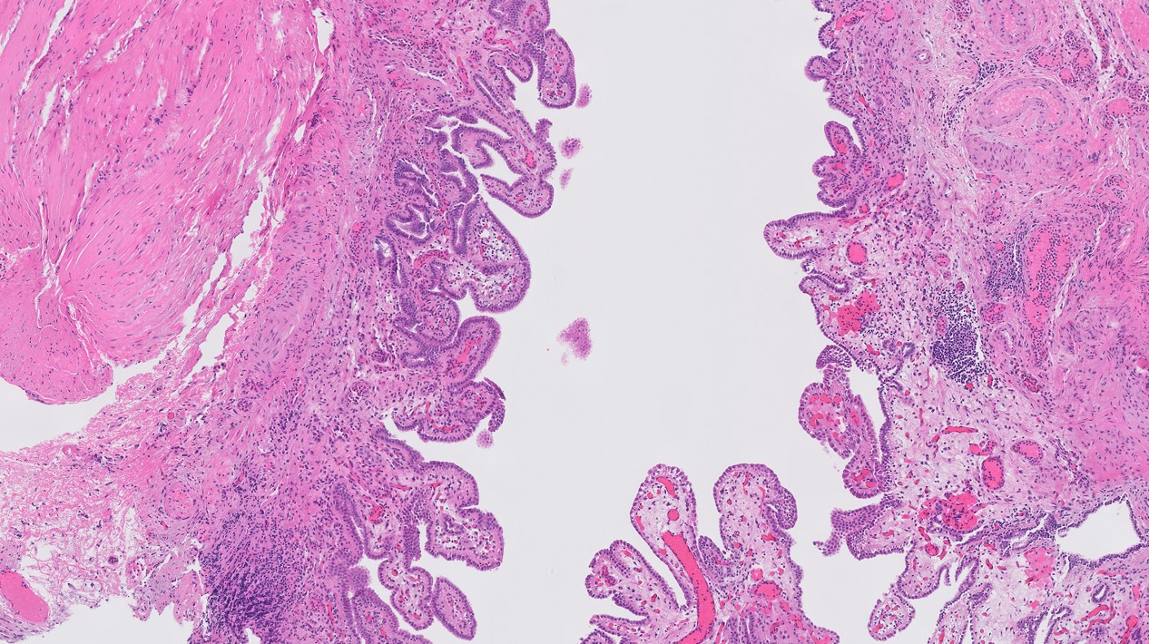 Microscopic image possibly detecting cancerous areas in human tissue