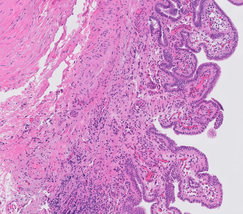 Microscopic image possibly detecting cancerous areas in human tissue