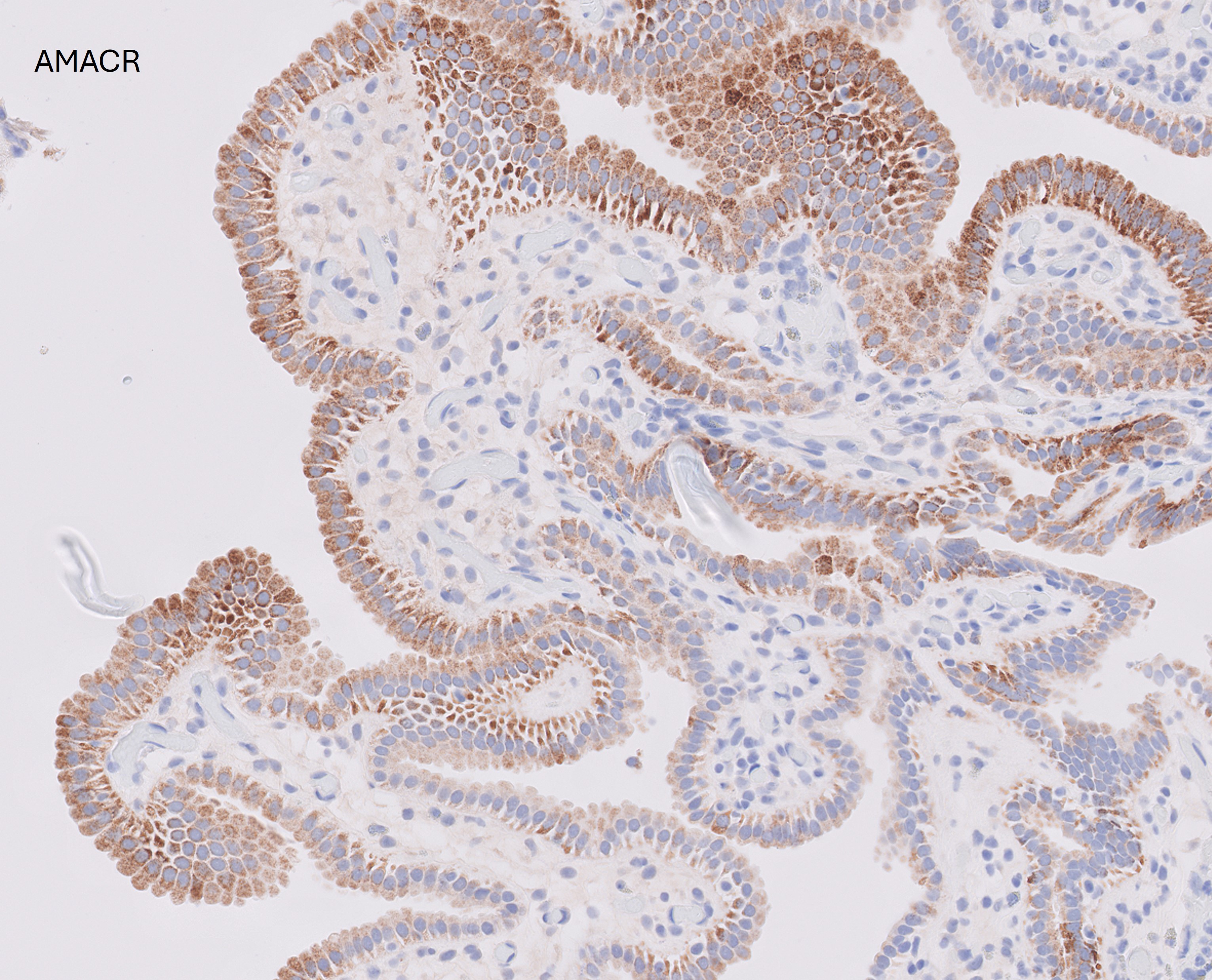 Microscopic image possibly detecting cancerous areas in human tissue