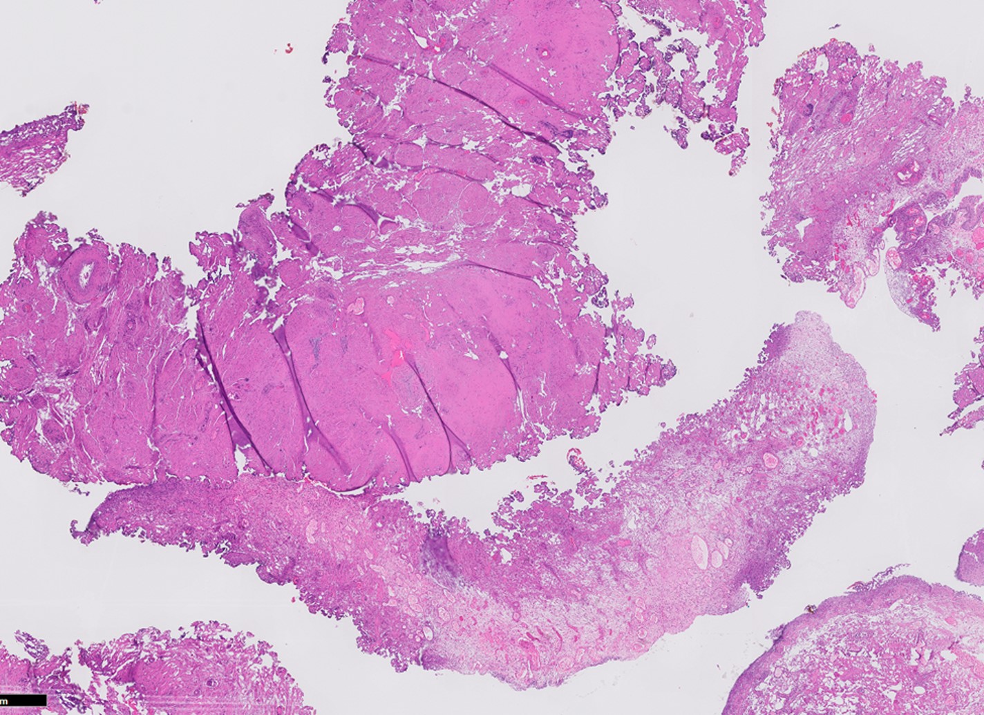 Microscopic image possibly detecting cancerous areas in human tissue