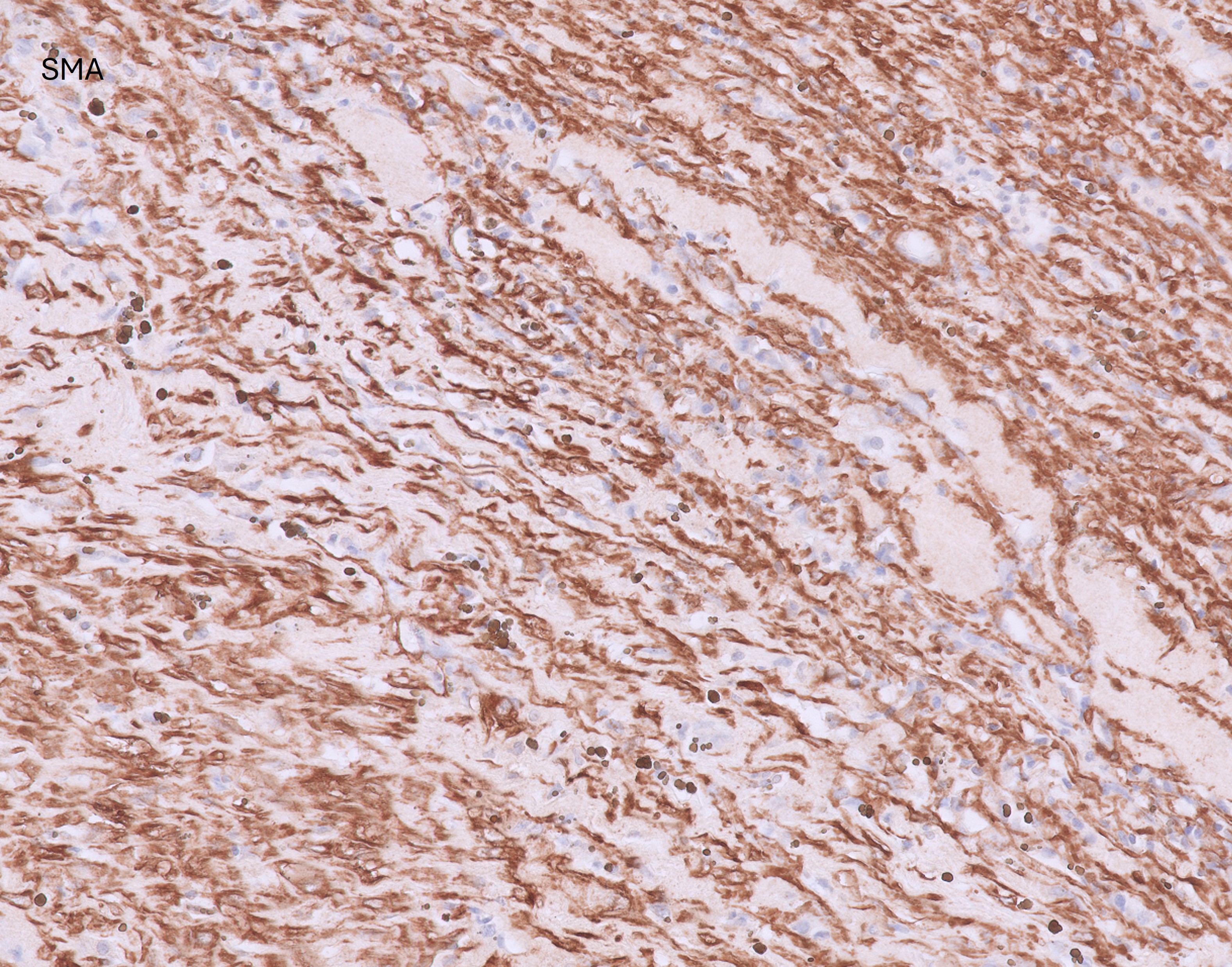 Microscopic image possibly detecting cancerous areas in human tissue