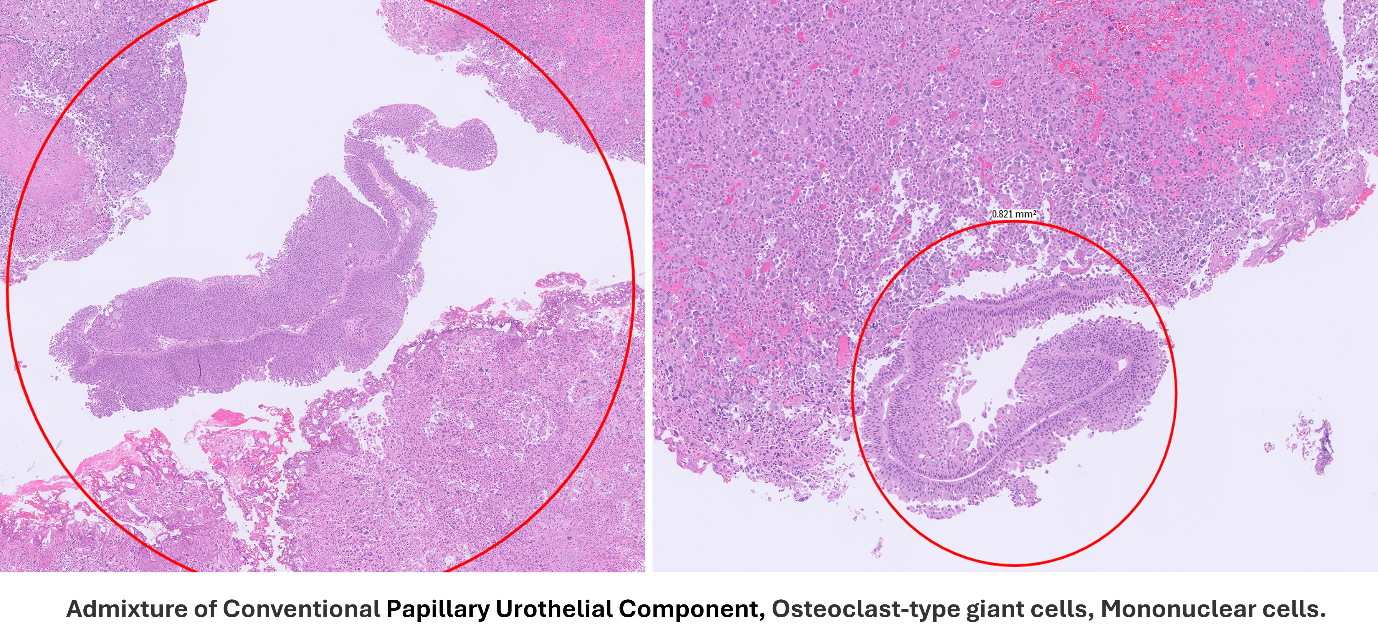 Microscopic image possibly detecting cancerous areas in human tissue