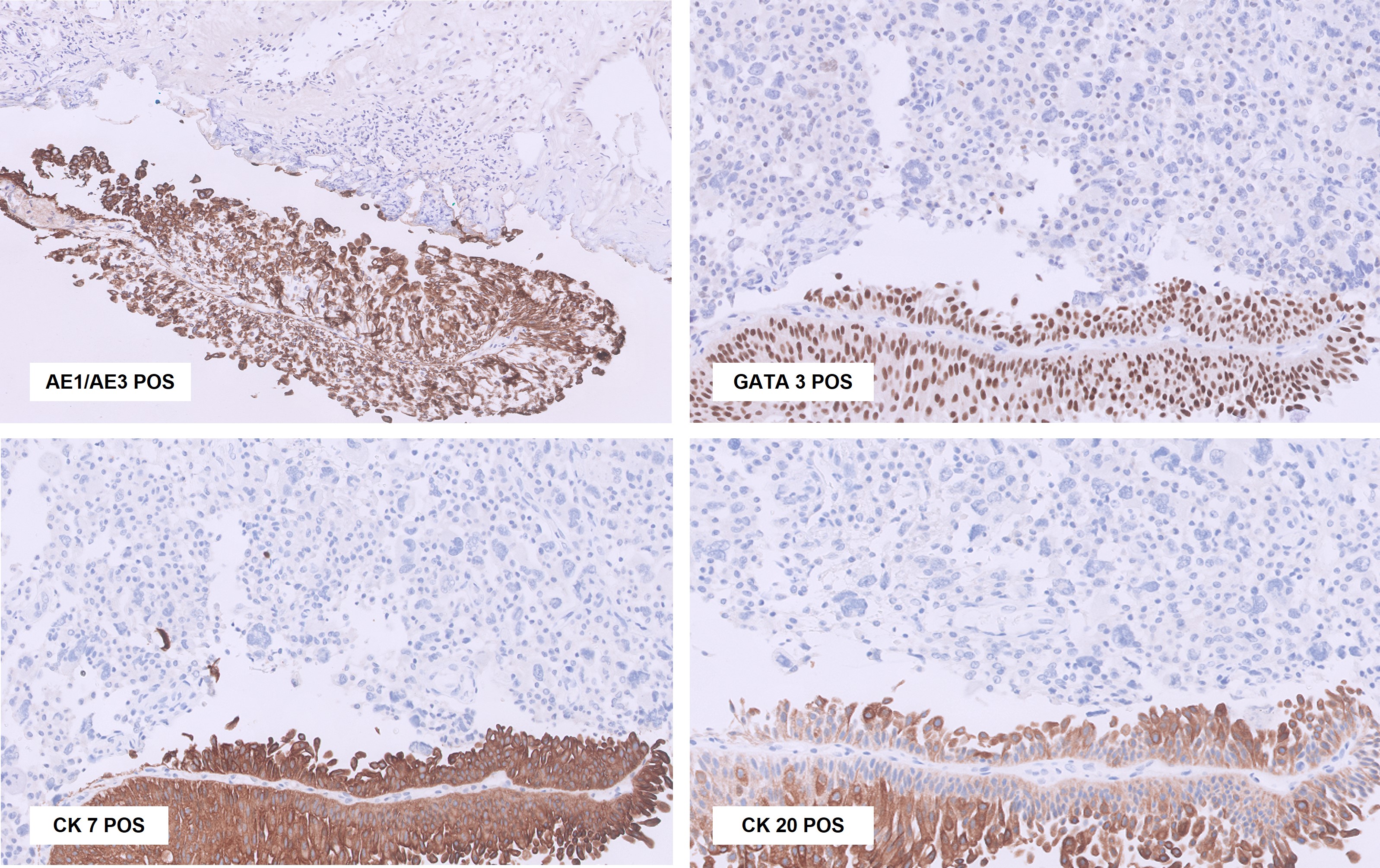 Microscopic image possibly detecting cancerous areas in human tissue