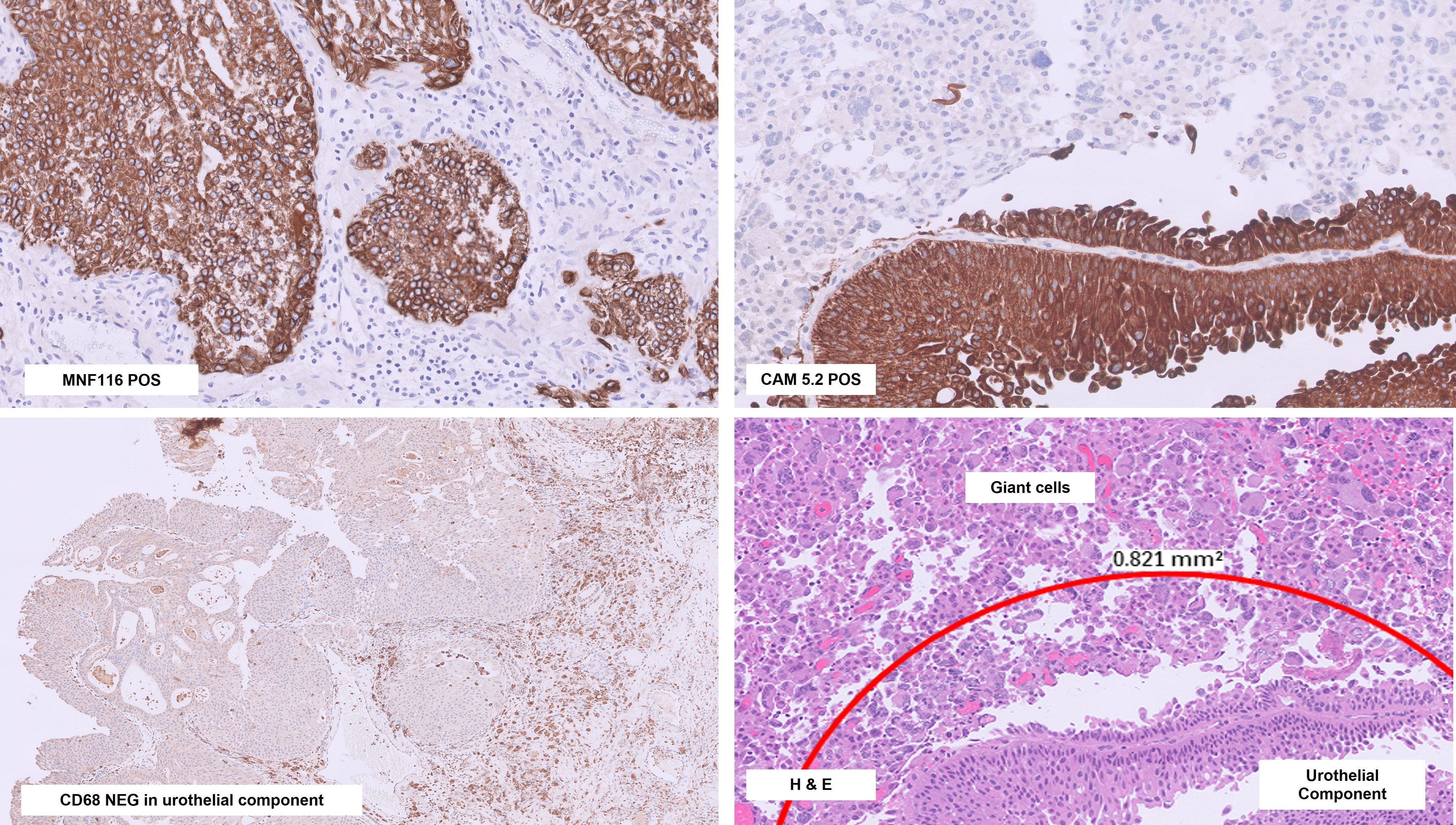 Microscopic image possibly detecting cancerous areas in human tissue