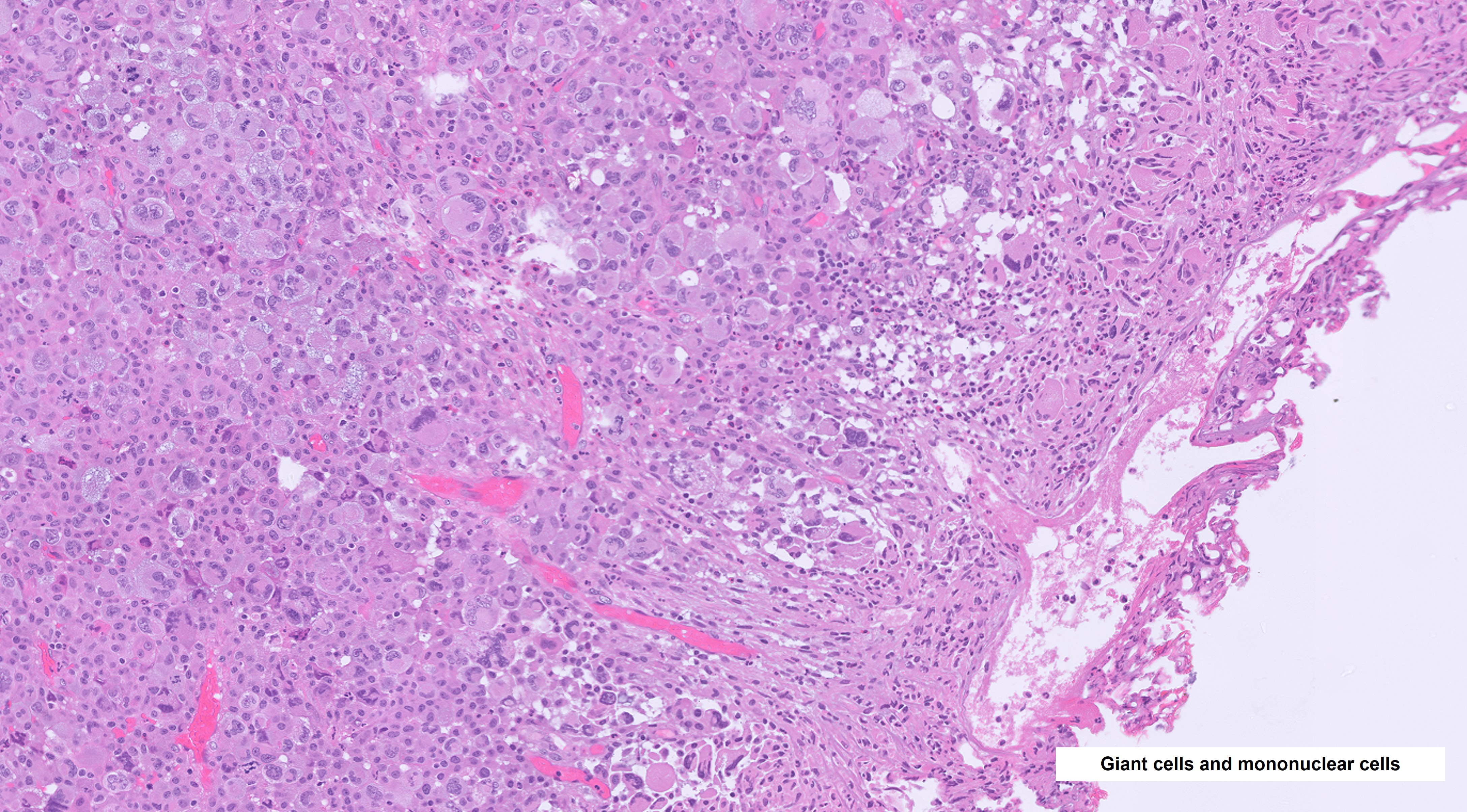 Microscopic image possibly detecting cancerous areas in human tissue