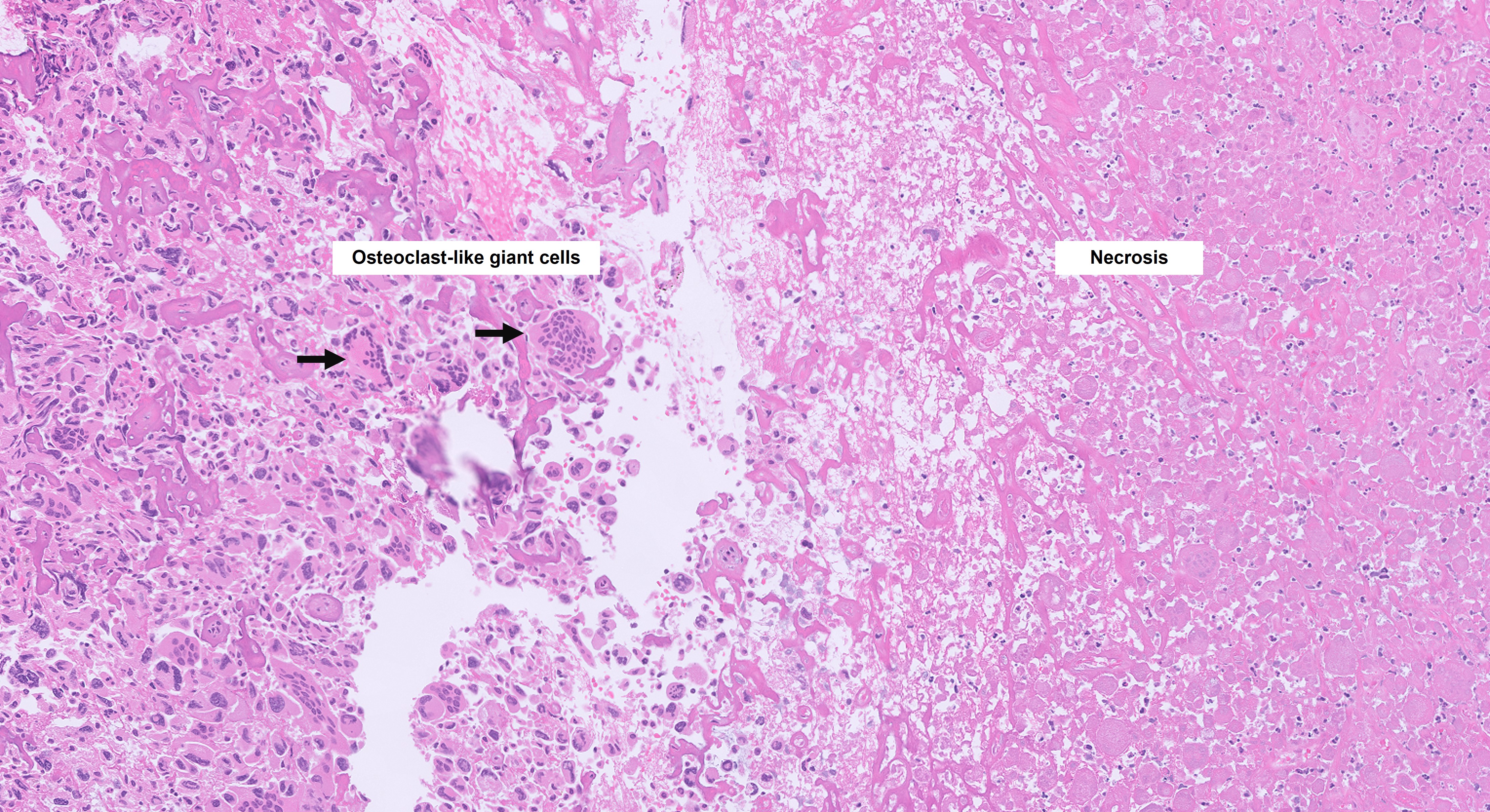 Microscopic image possibly detecting cancerous areas in human tissue