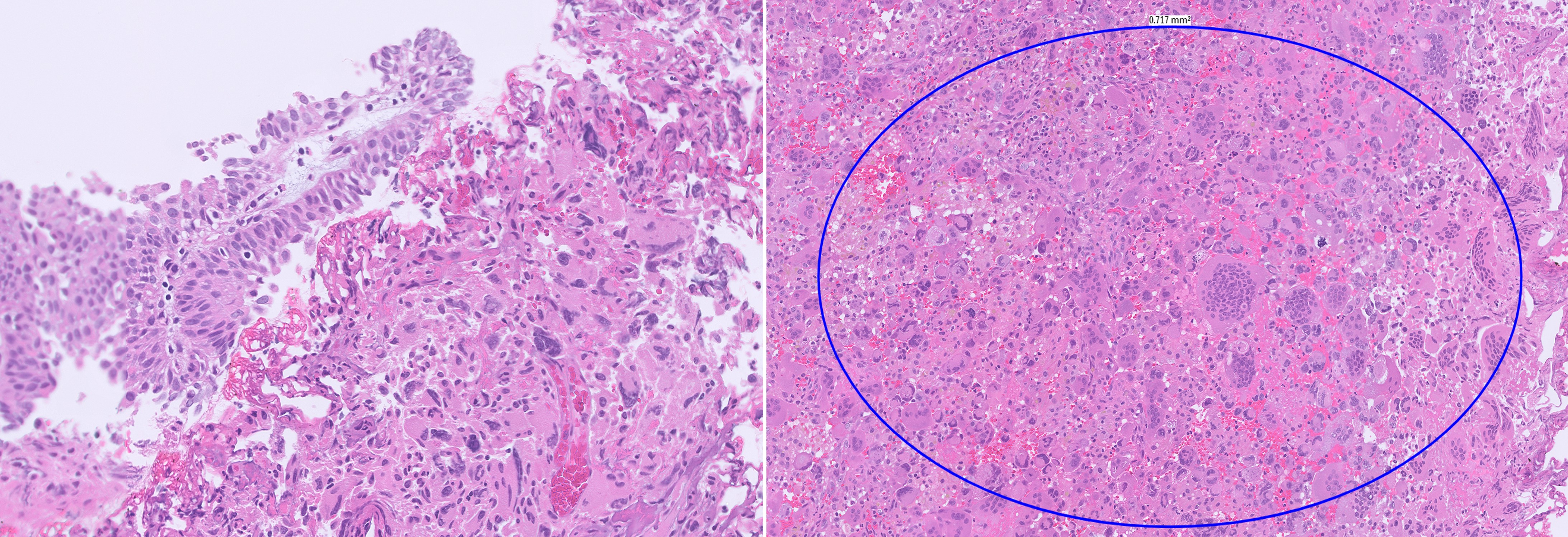 Microscopic image possibly detecting cancerous areas in human tissue