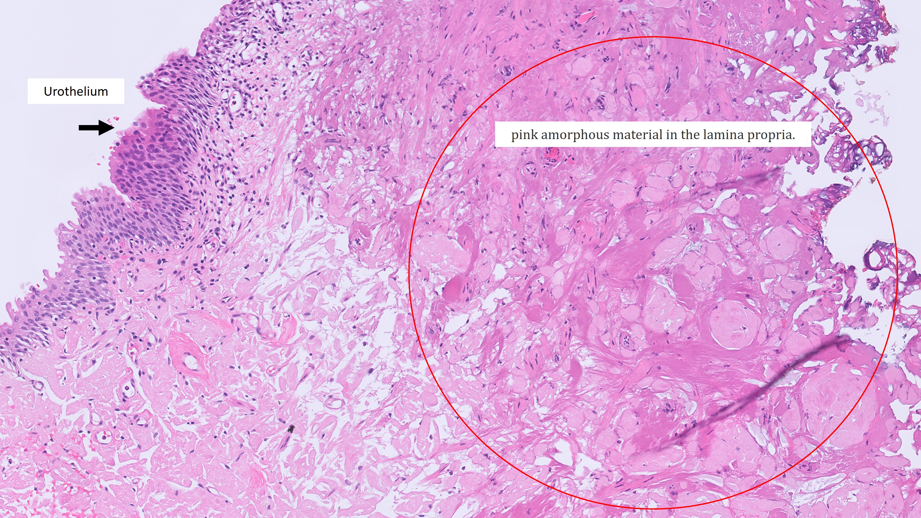 Microscopic image possibly detecting cancerous areas in human tissue