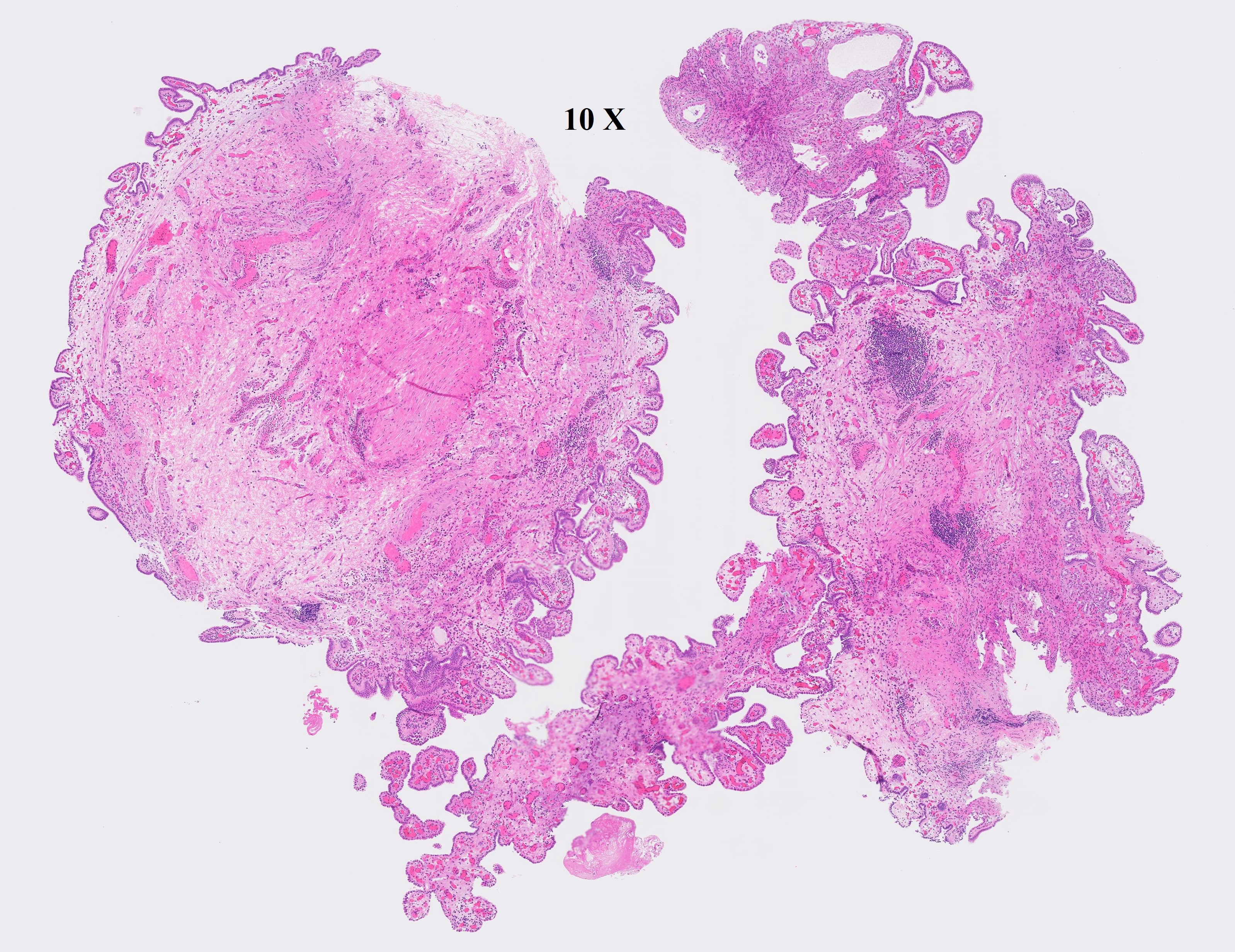 Microscopic image possibly detecting cancerous areas in human tissue