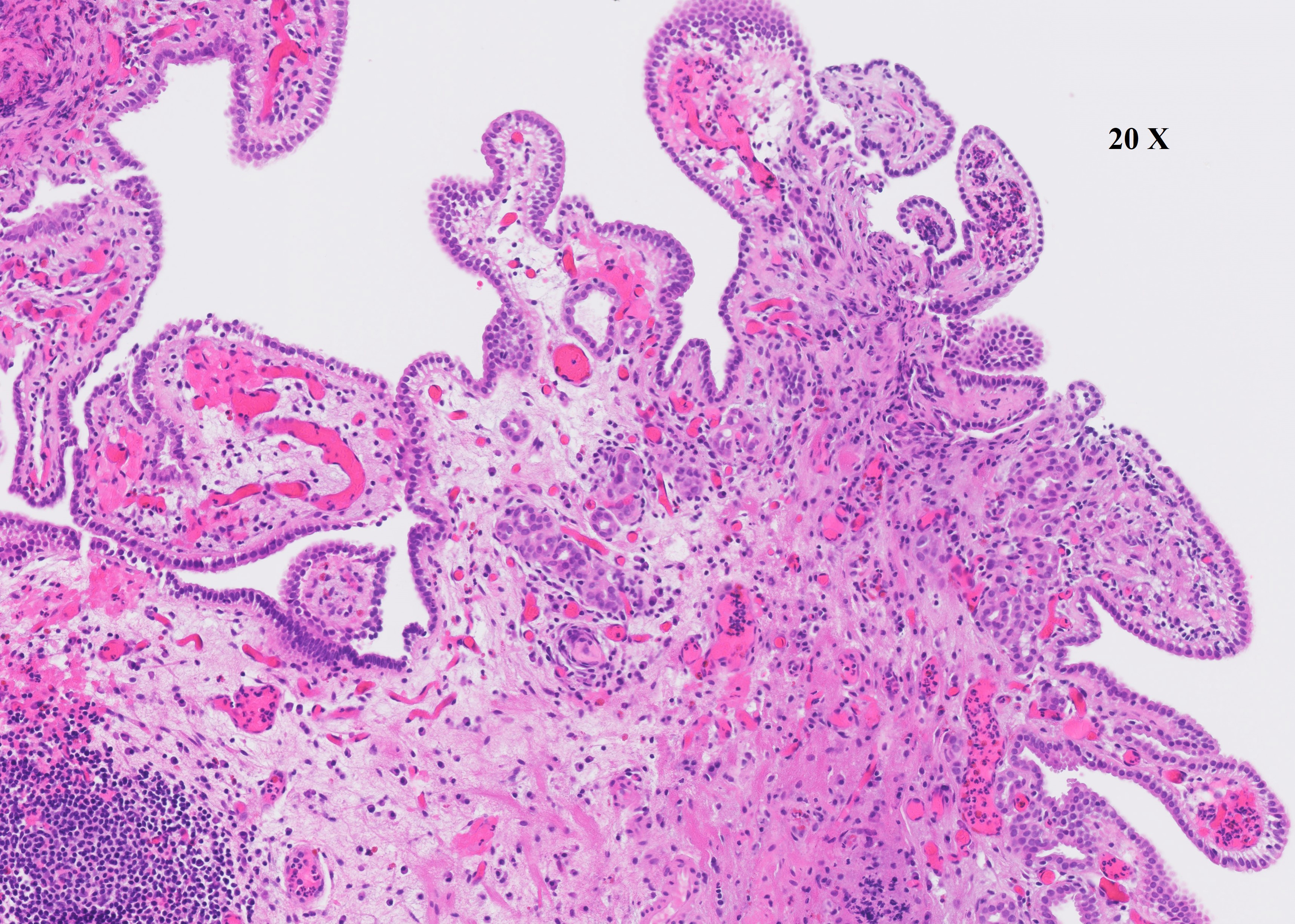 Microscopic image possibly detecting cancerous areas in human tissue