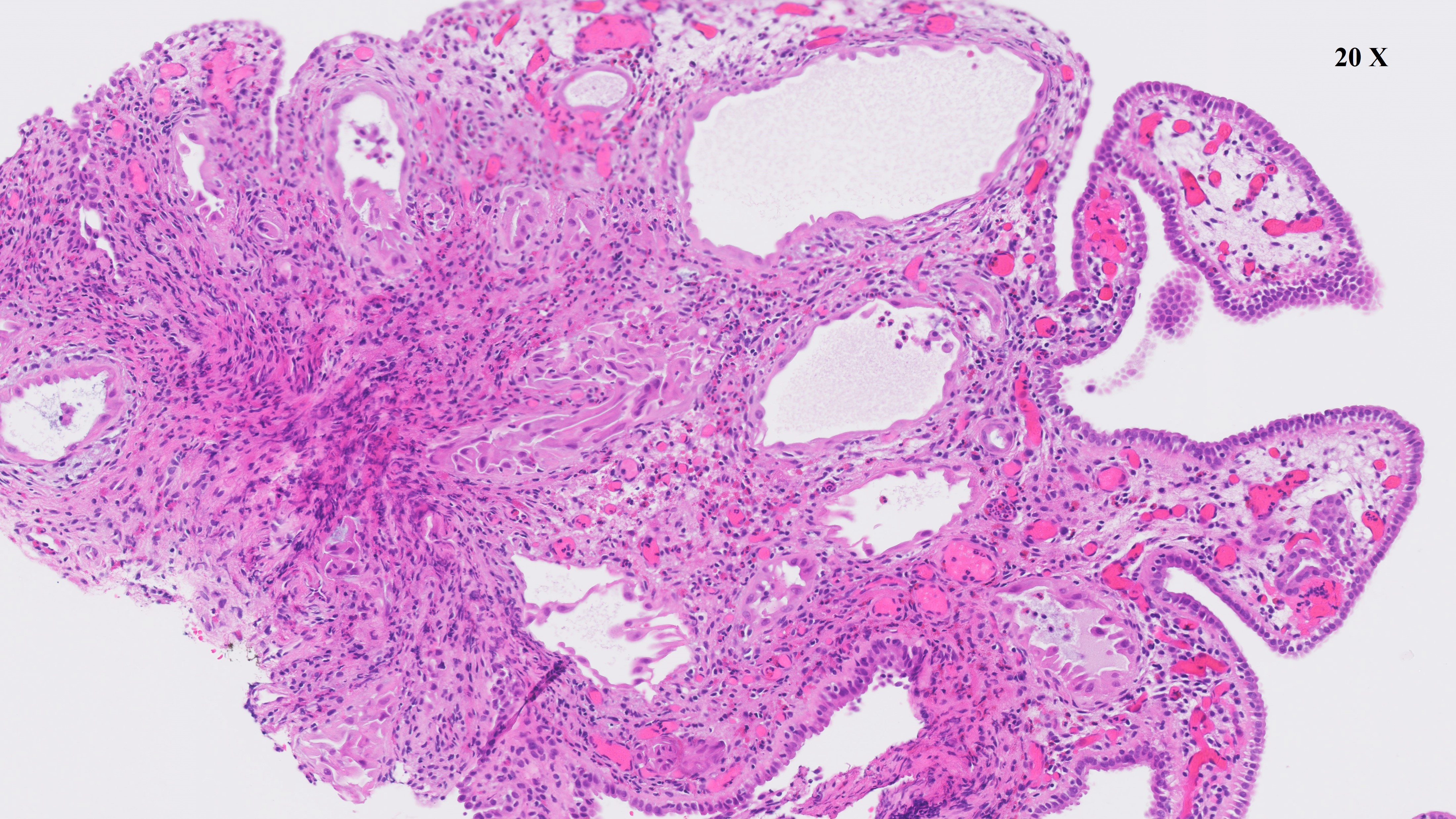 Microscopic image possibly detecting cancerous areas in human tissue