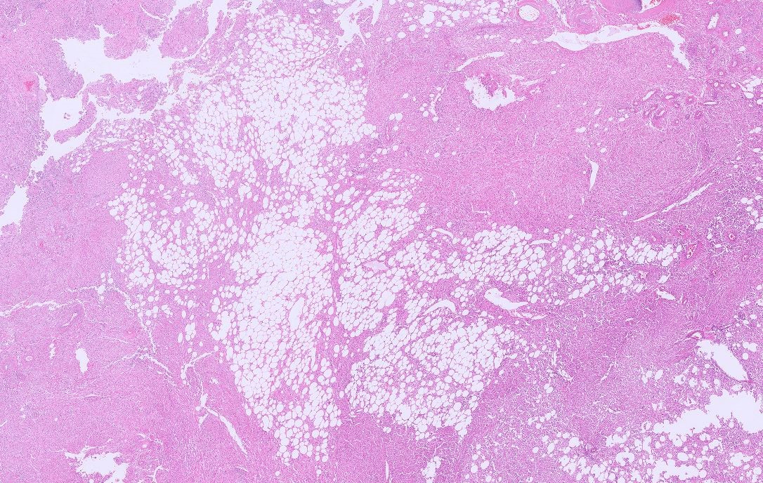 Microscopic image possibly detecting cancerous areas in human tissue