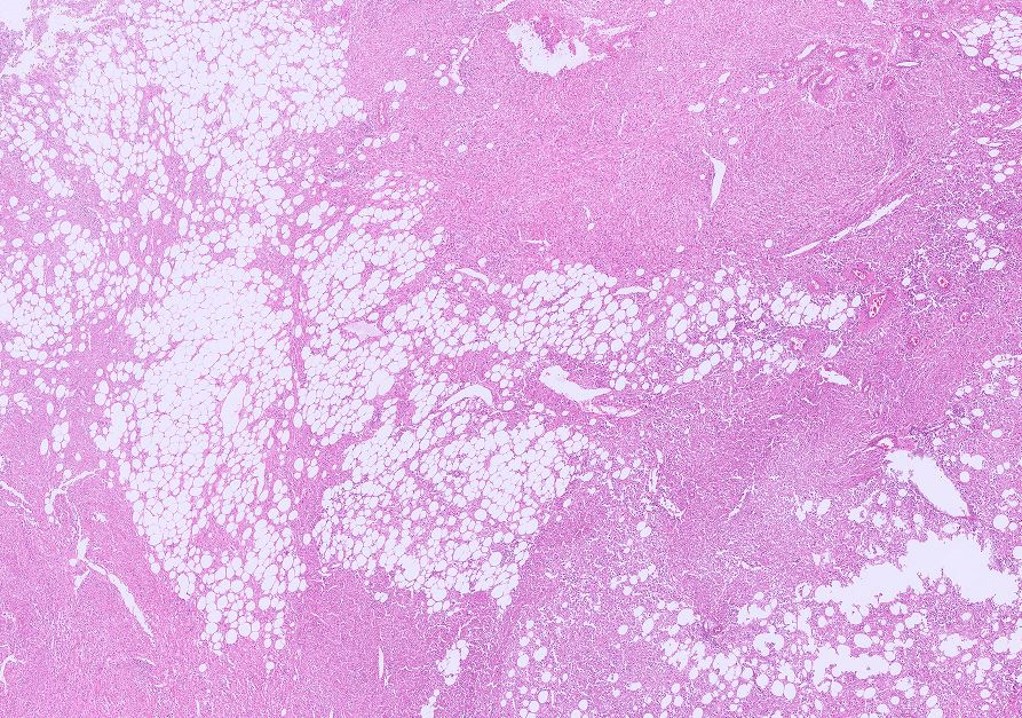 Microscopic image possibly detecting cancerous areas in human tissue