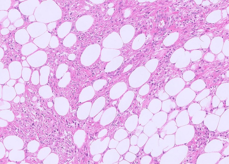 Microscopic image possibly detecting cancerous areas in human tissue
