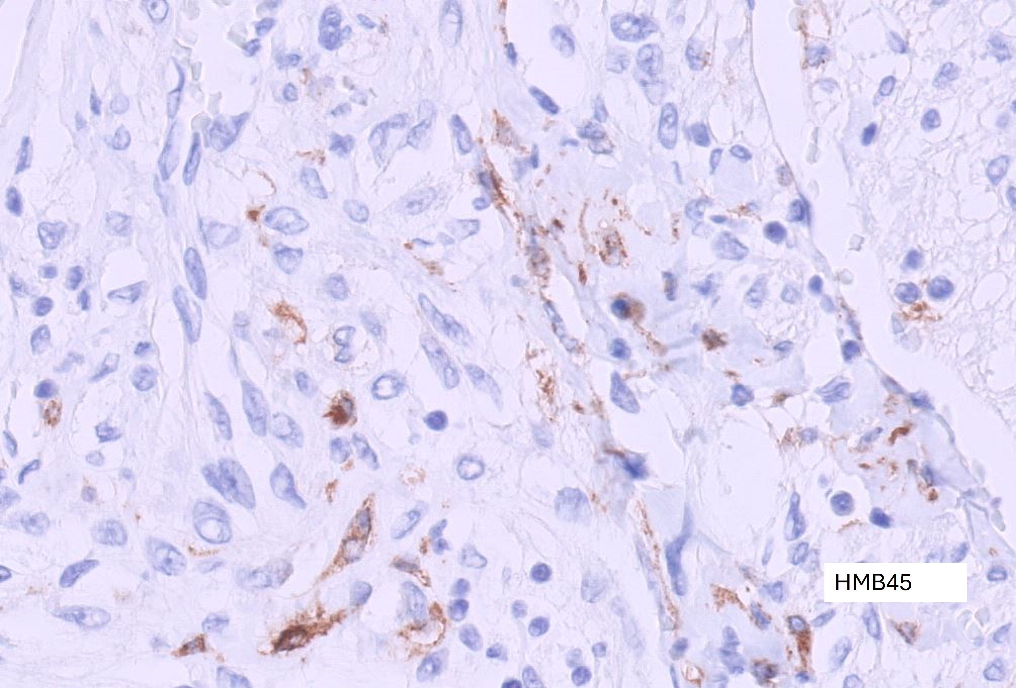 Microscopic image possibly detecting cancerous areas in human tissue