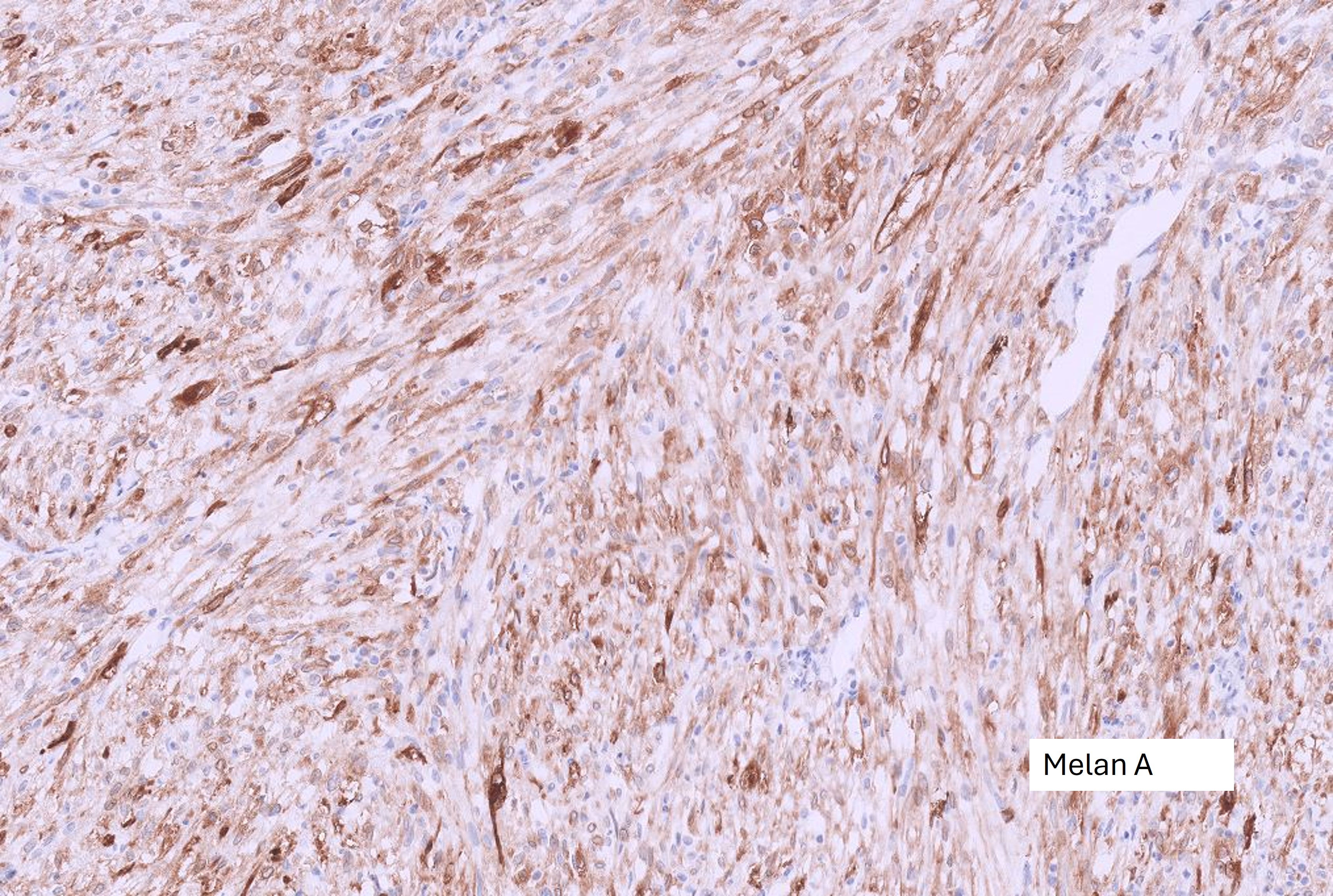 Microscopic image possibly detecting cancerous areas in human tissue