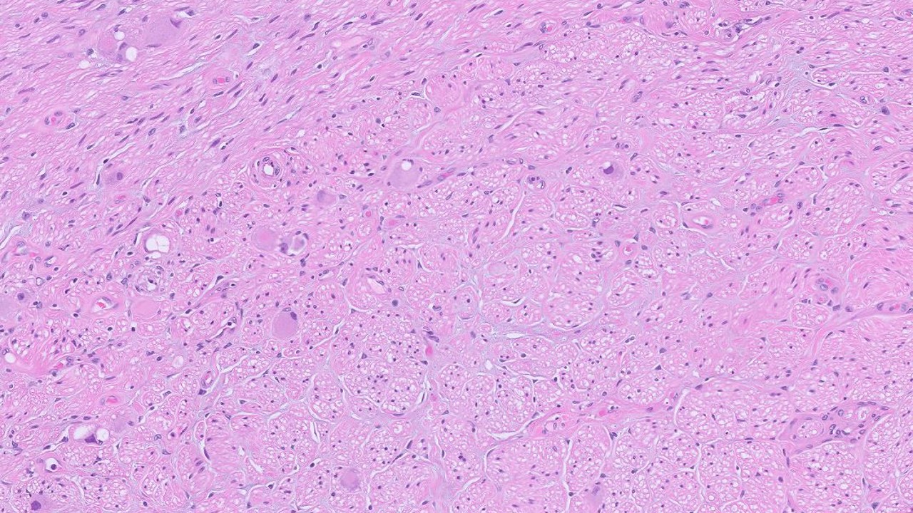 Microscopic image possibly detecting cancerous areas in human tissue