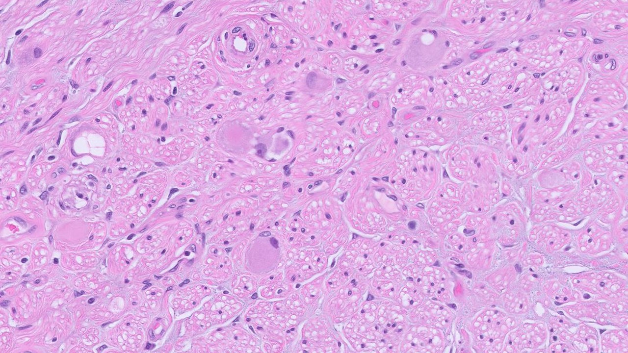 Microscopic image possibly detecting cancerous areas in human tissue