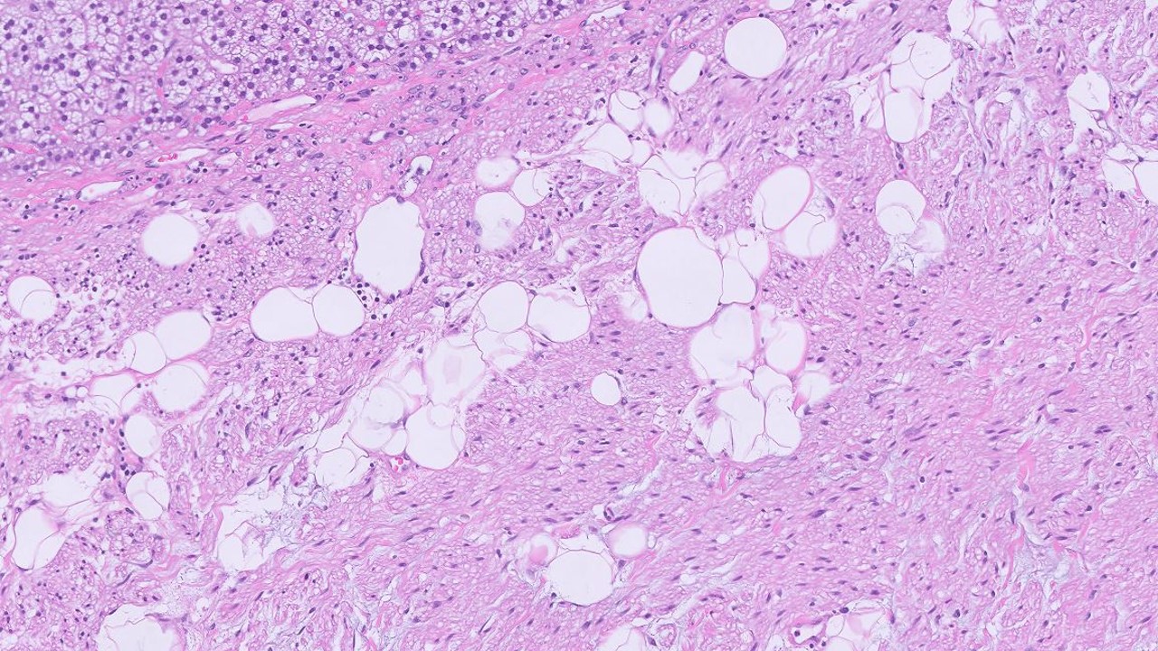 Microscopic image possibly detecting cancerous areas in human tissue