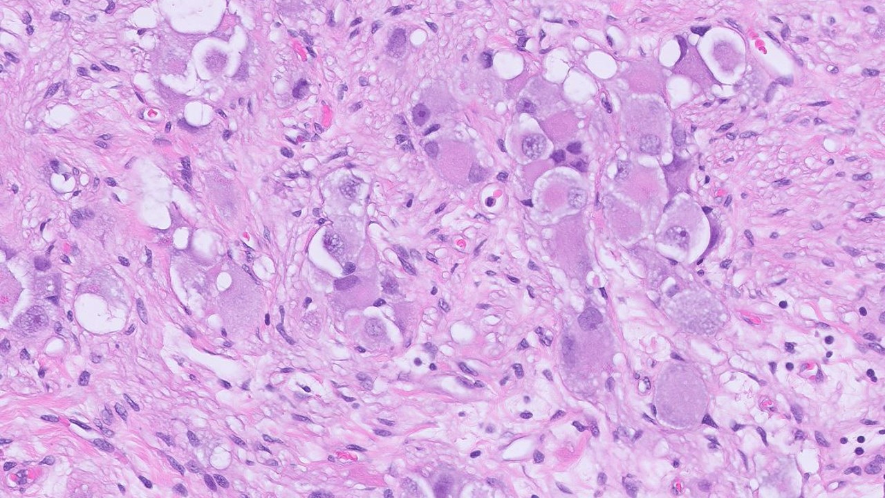 Microscopic image possibly detecting cancerous areas in human tissue