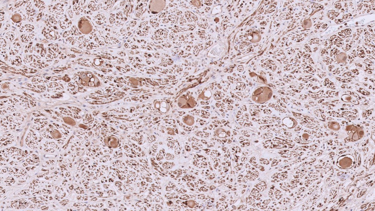 Microscopic image possibly detecting cancerous areas in human tissue