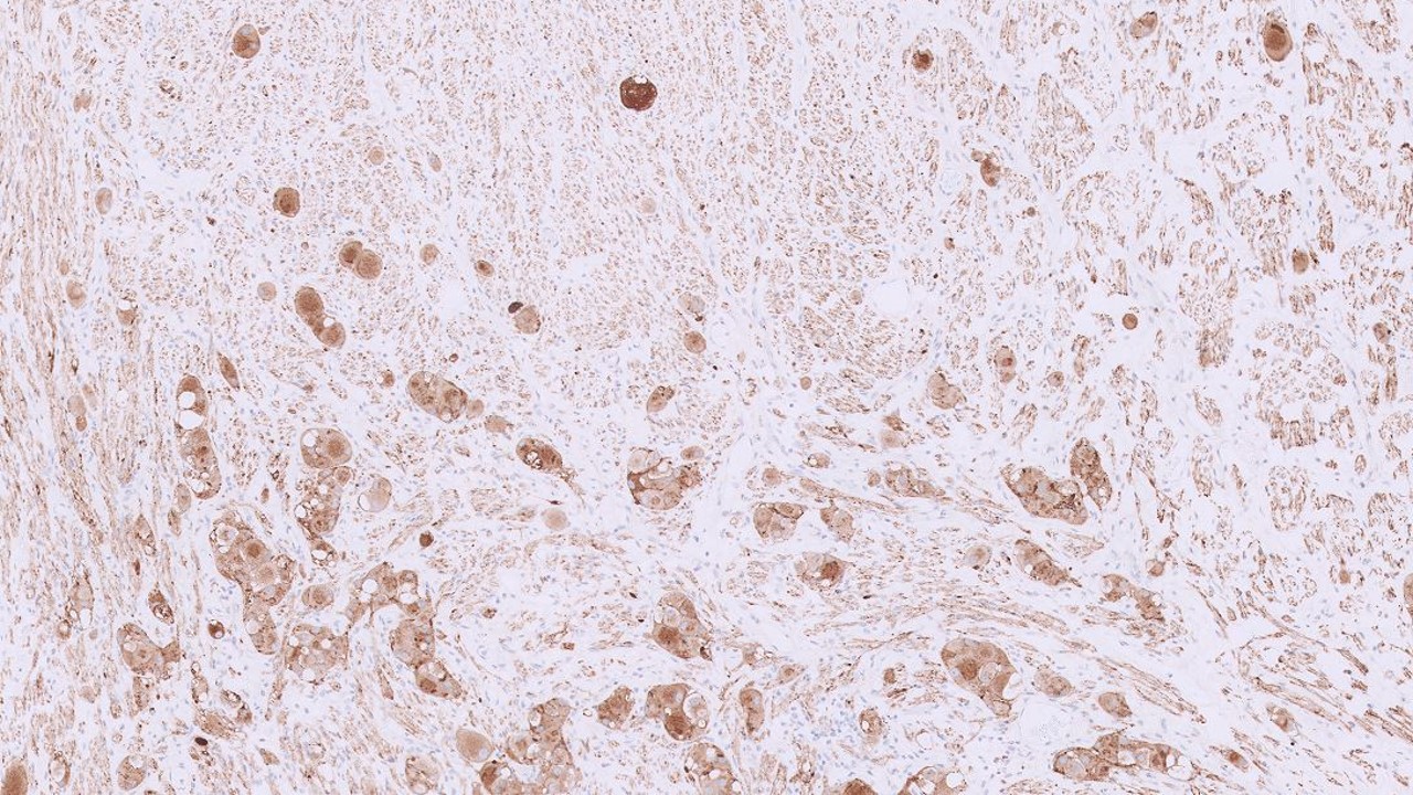 Microscopic image possibly detecting cancerous areas in human tissue