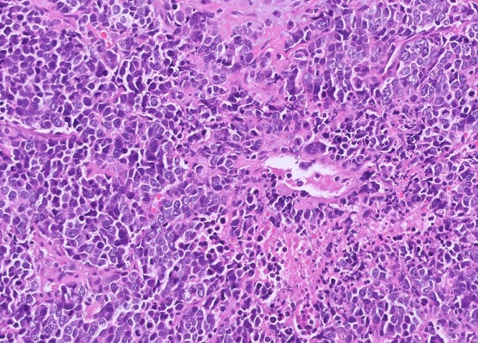 Microscopic image possibly detecting cancerous areas in human tissue