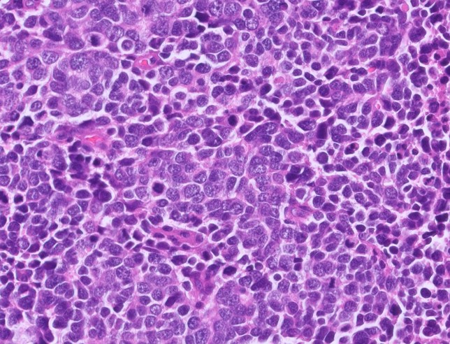 Microscopic image possibly detecting cancerous areas in human tissue