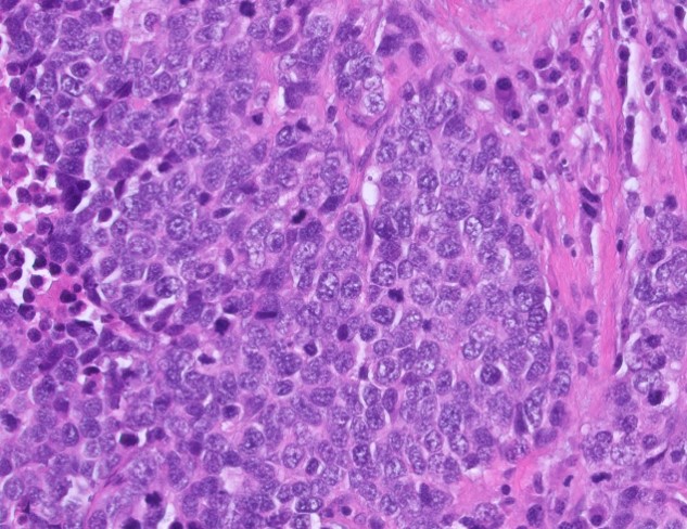 Microscopic image possibly detecting cancerous areas in human tissue