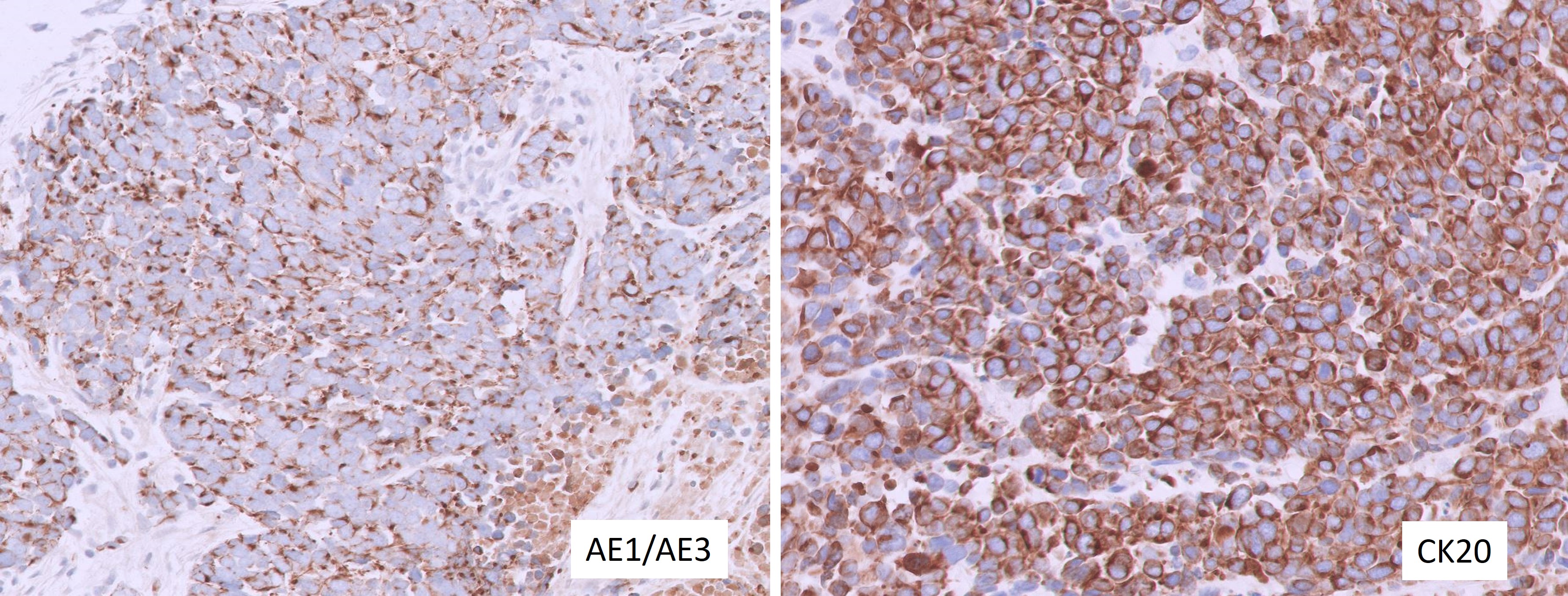 Microscopic image possibly detecting cancerous areas in human tissue