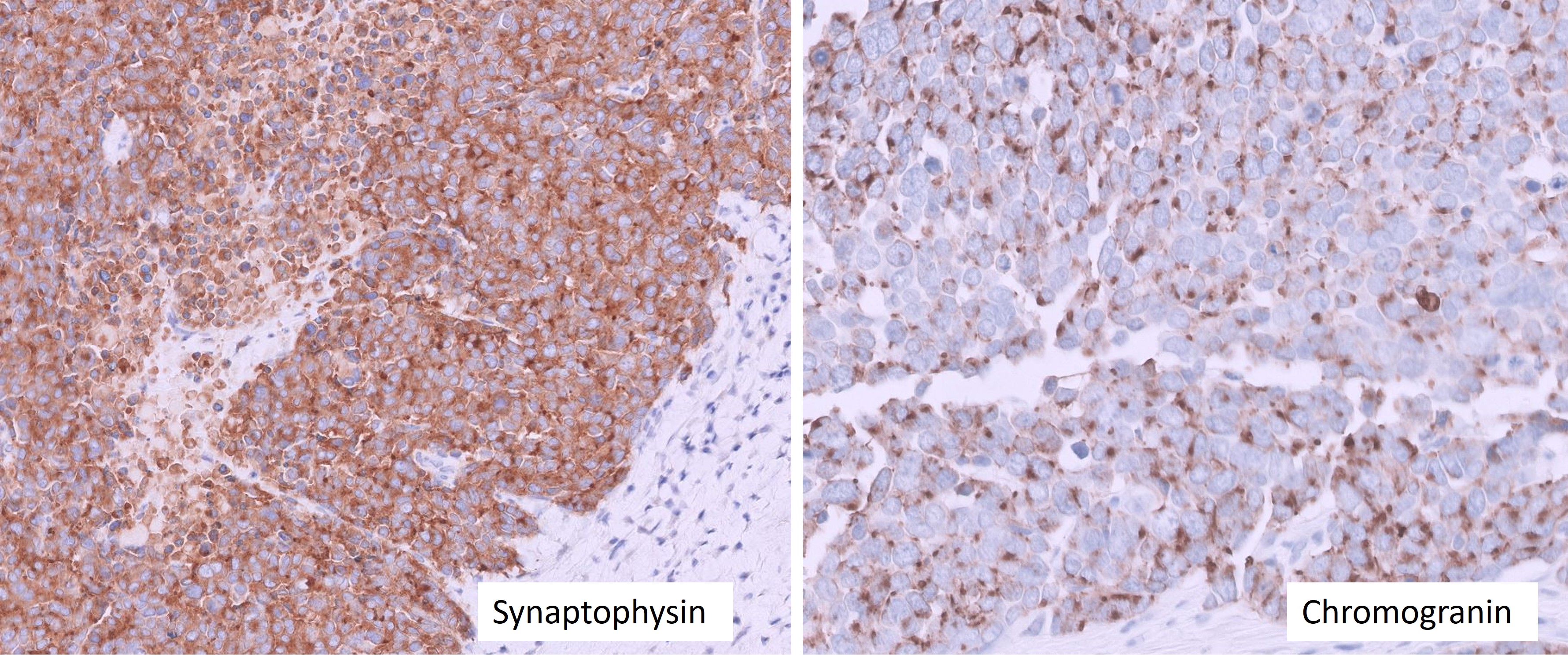 Microscopic image possibly detecting cancerous areas in human tissue
